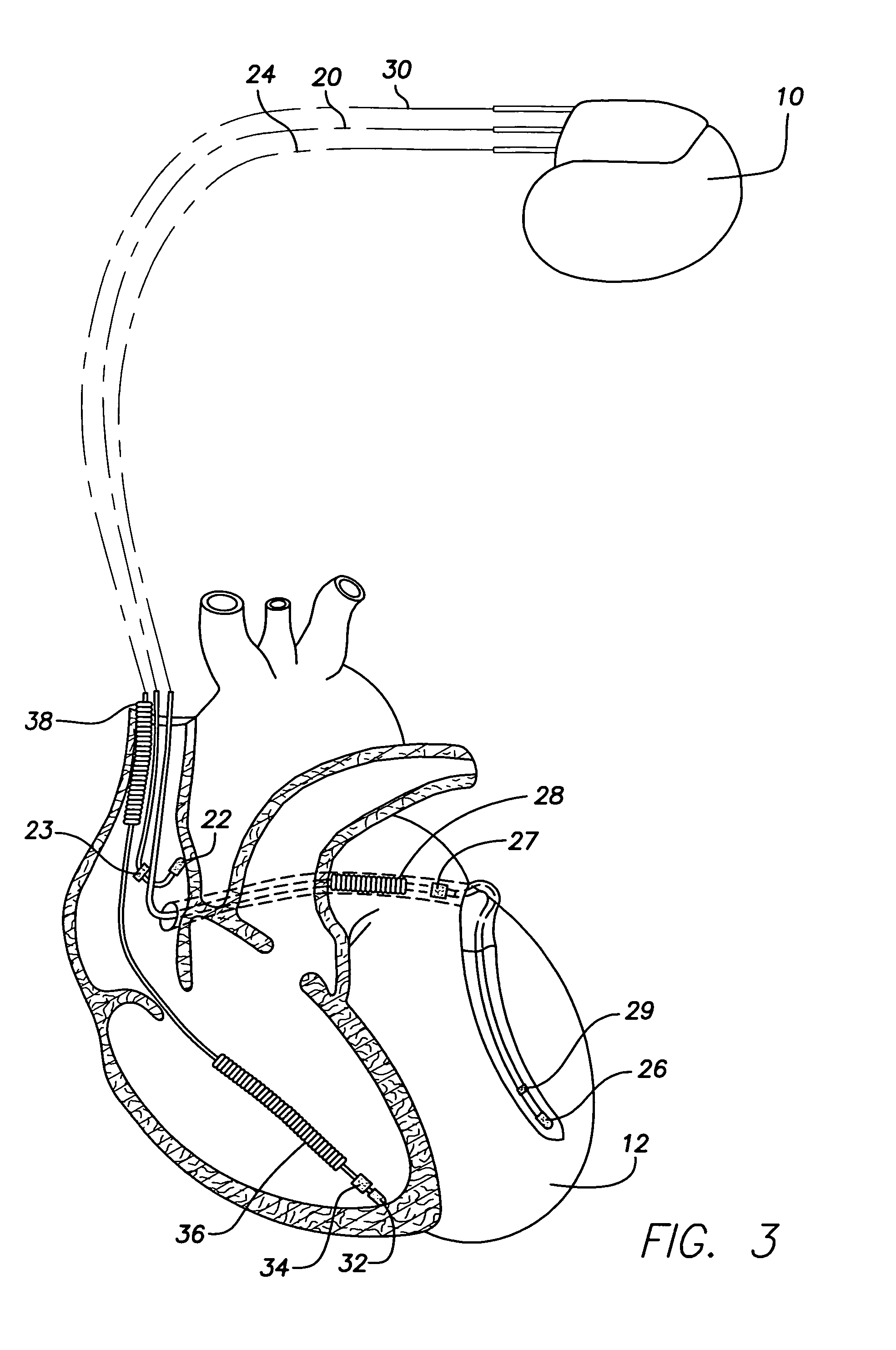 System and method for emulating a surface EKG for use with transtelephonic monitoring of an implantable medical device