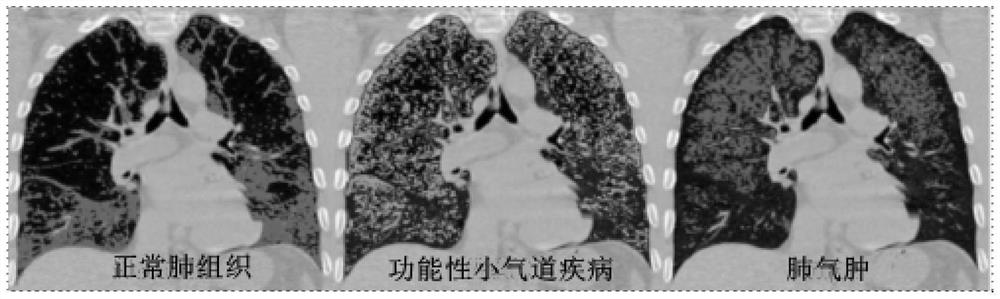 Lung function small airway disease prediction system and method, medium and electronic equipment