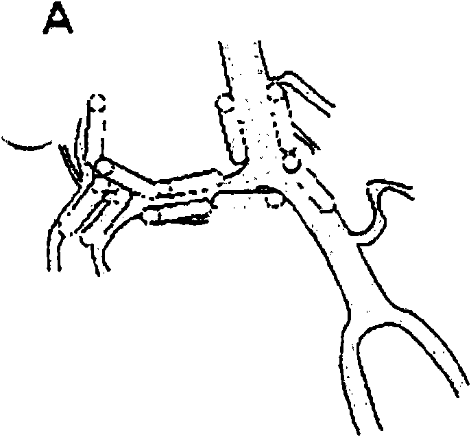 A drug delivery system for the prevention of cerebral vasospasm