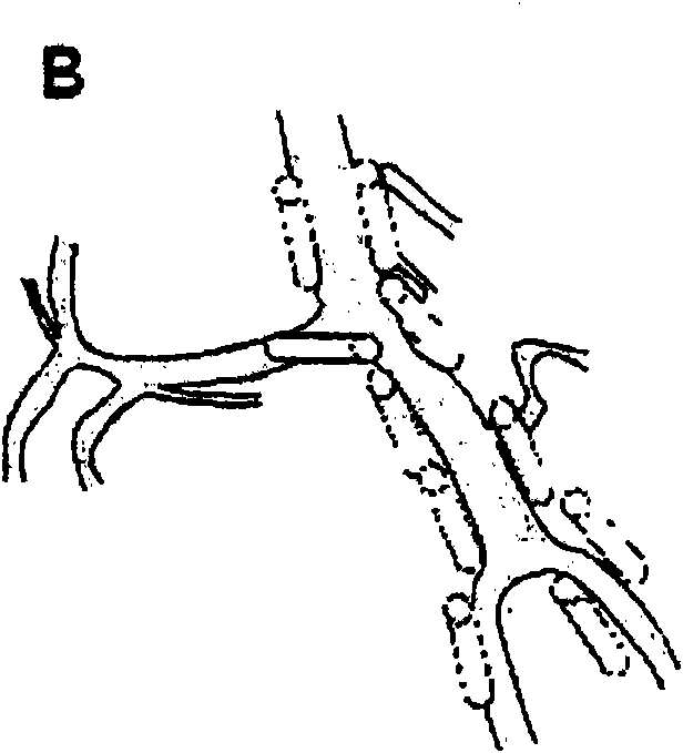 A drug delivery system for the prevention of cerebral vasospasm