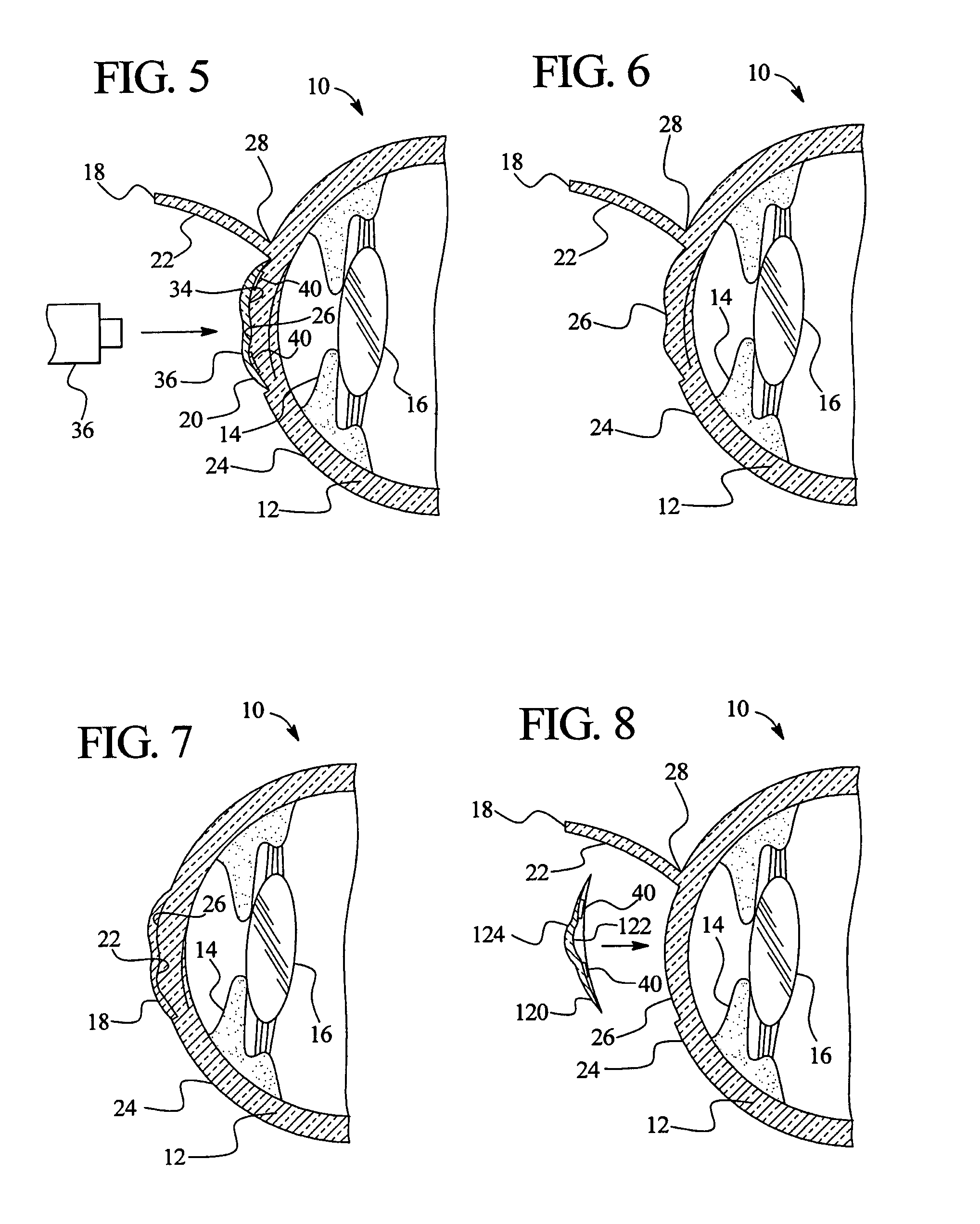 Method of reshaping the cornea by controlled thermal delivery