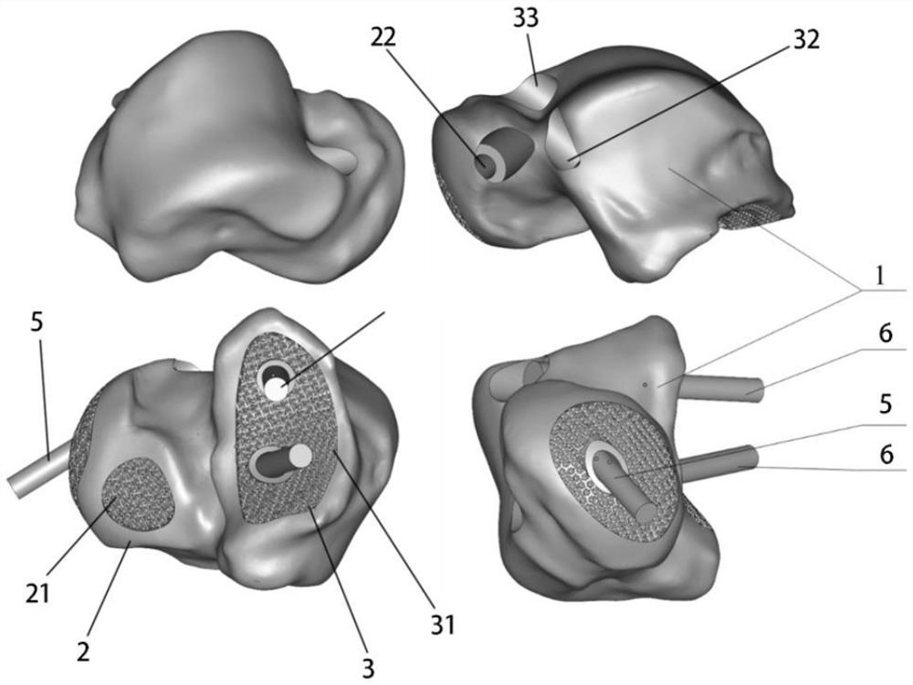 Full talus prosthesis with porous core and preparation method