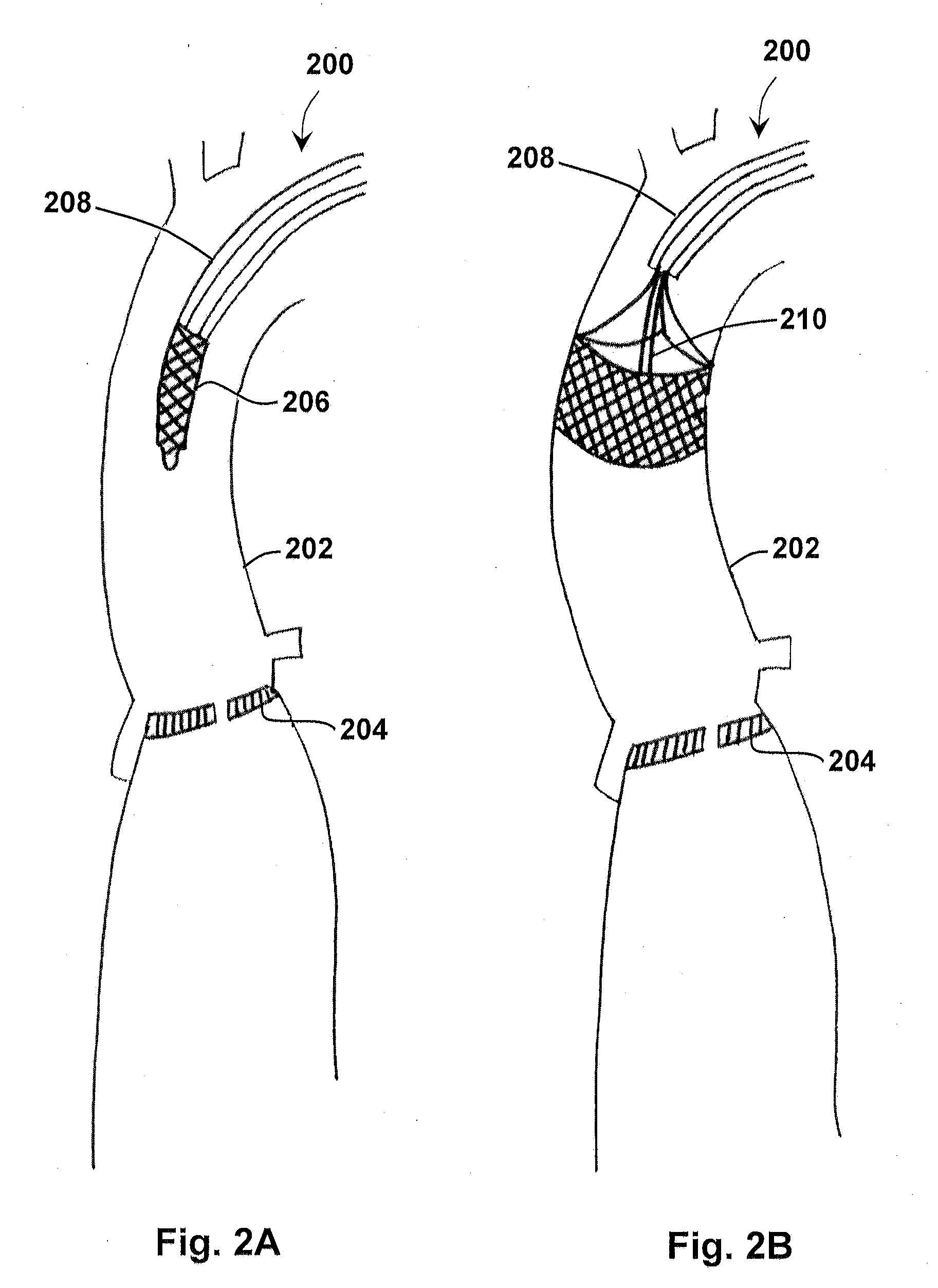 Methods for removing a valve from a vessel