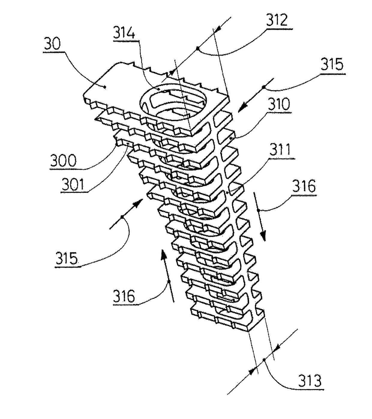 Tibial tuberosity advancement cage for ACL injuries