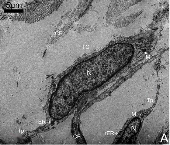 Prognostic evaluation method for hepatocellular carcinoma through Telocytes