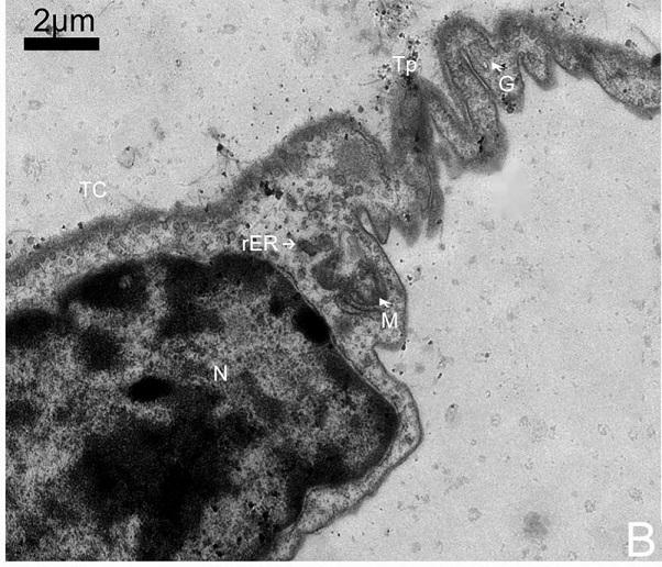 Prognostic evaluation method for hepatocellular carcinoma through Telocytes