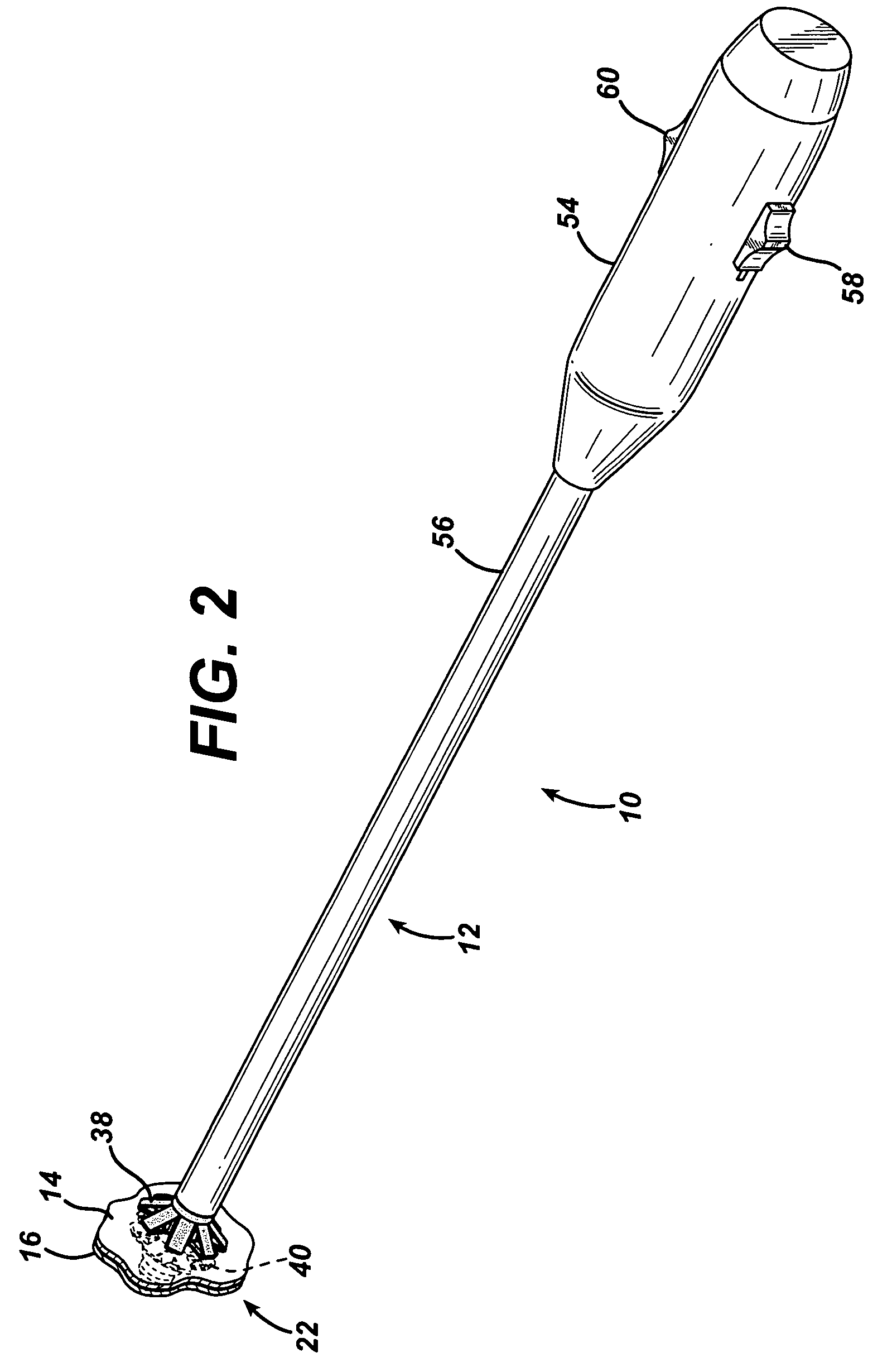 Single lumen access deployable ring for intralumenal anastomosis