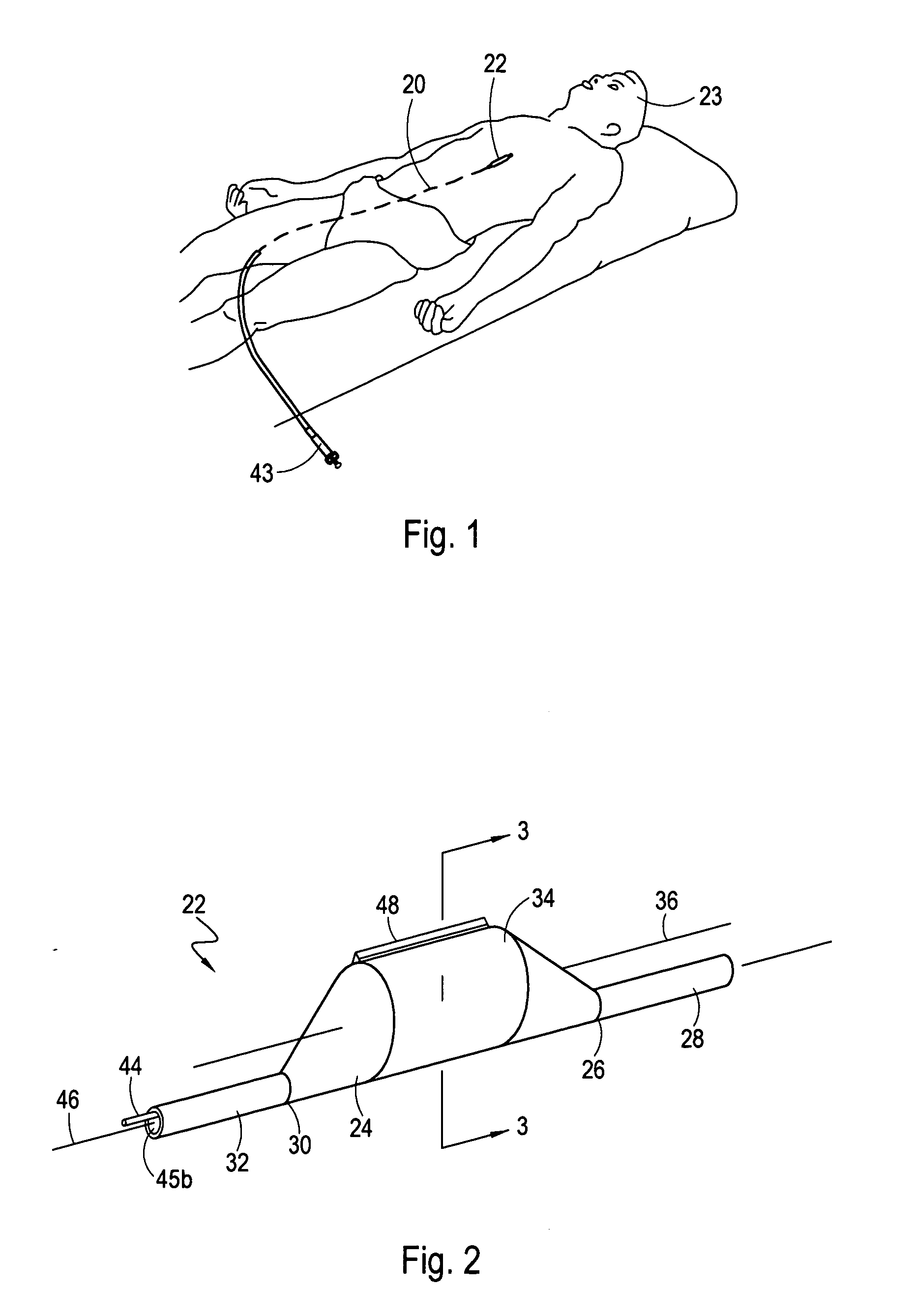 Directional cutting balloon