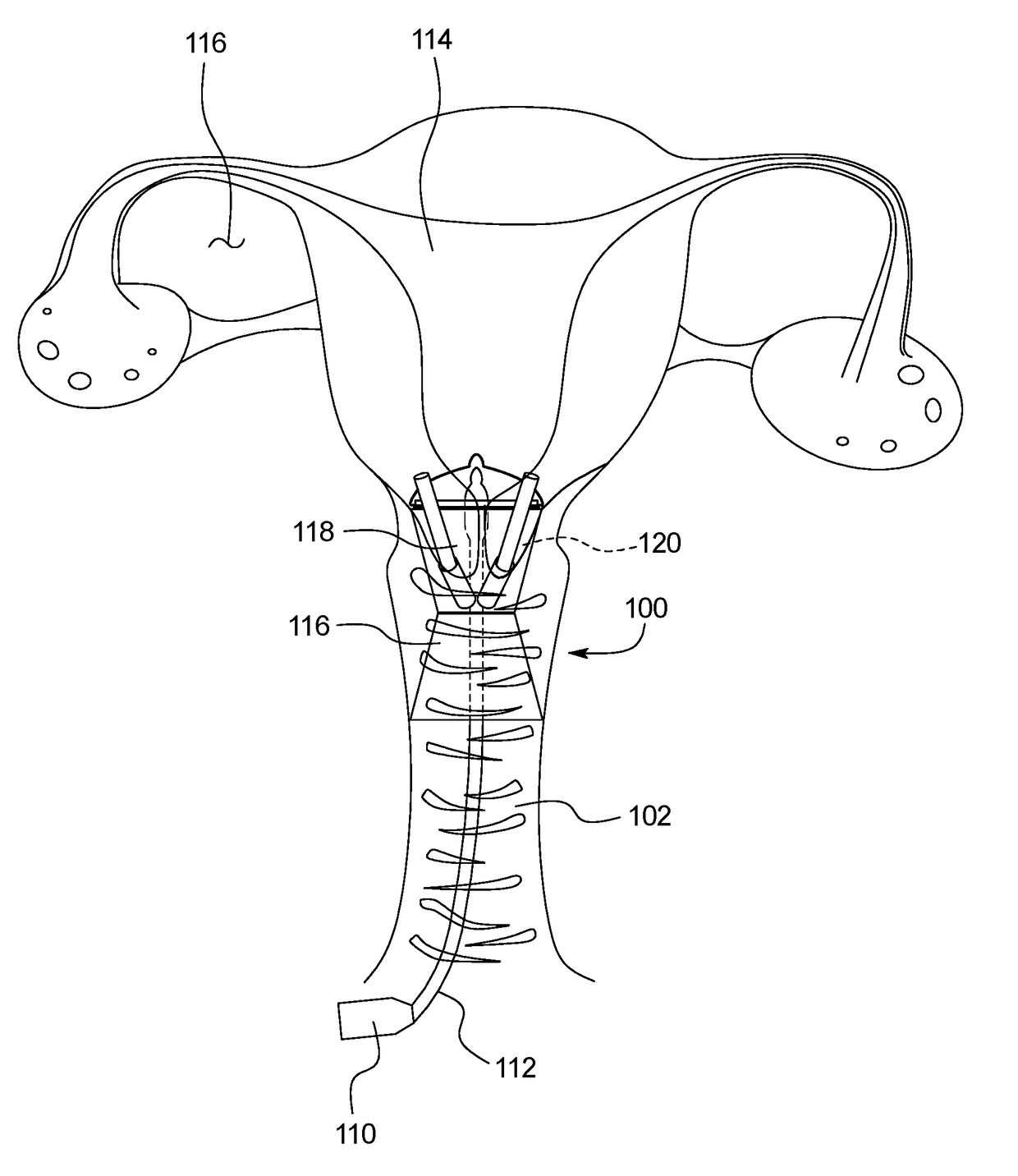 Uterine manipulator device with cutting element