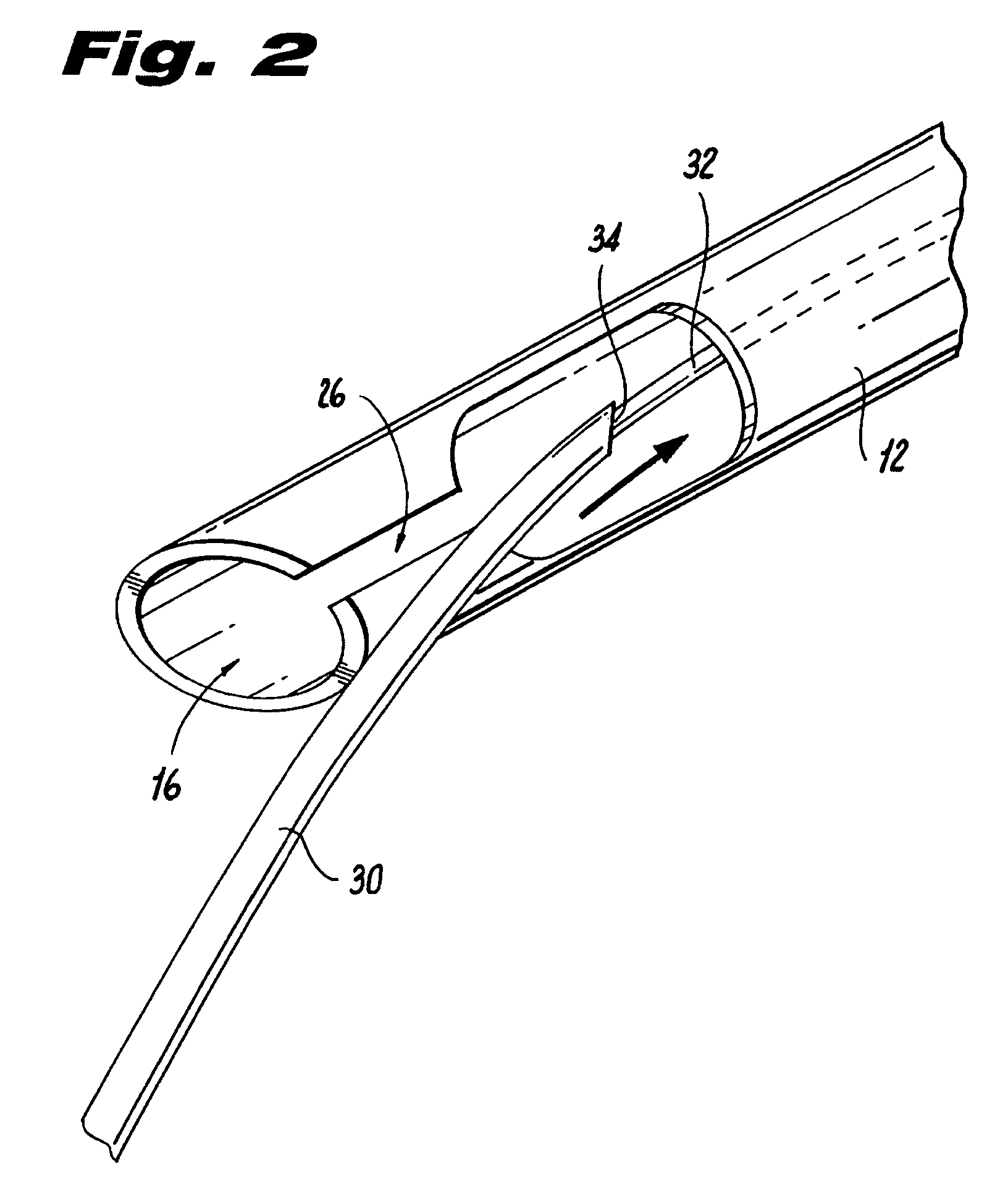 Endoluminal colostomy system and procedure