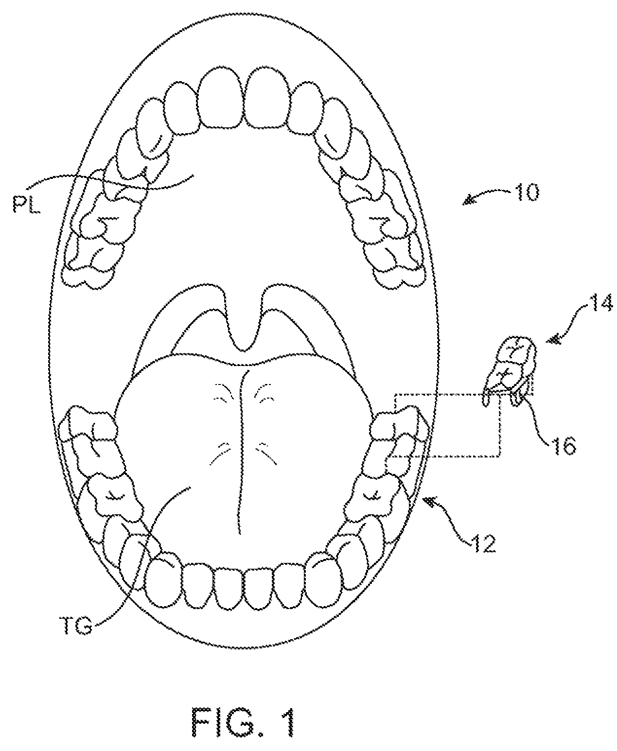 Stuttering treatment methods and apparatus