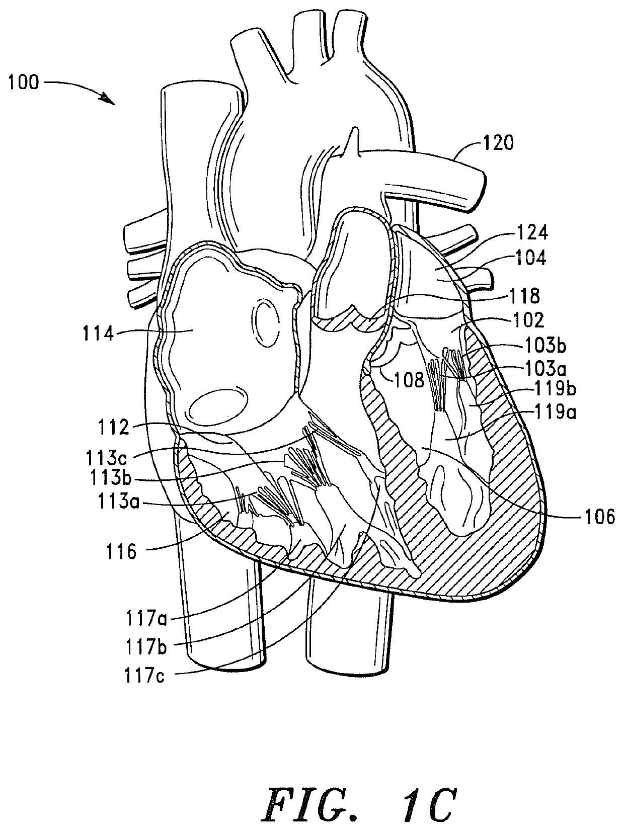 Prosthetic Cardiovascular Valves and Methods for Replacing Native Atrioventricular Valves with Same