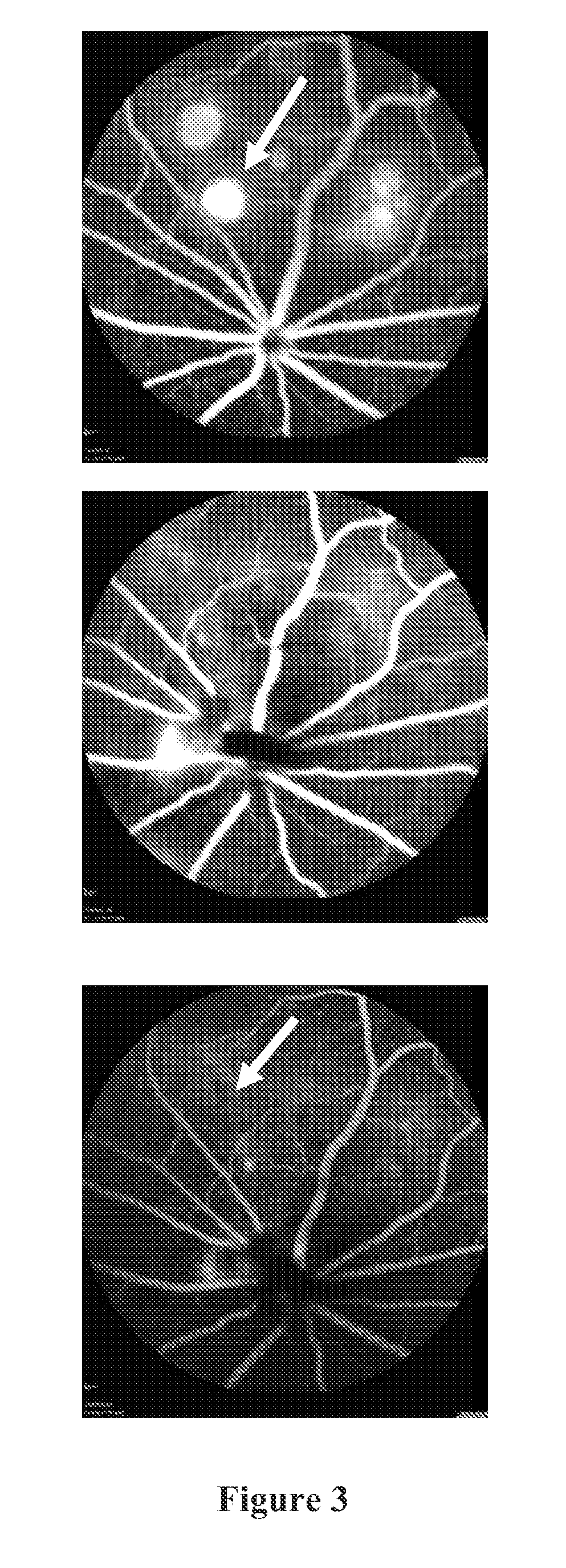 Compositions and methods for treating ocular diseases