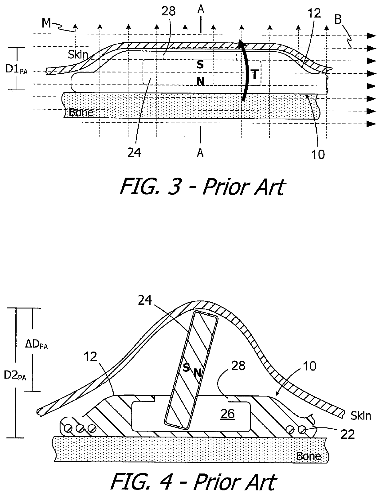 Cochlear implants and magnets for use with same