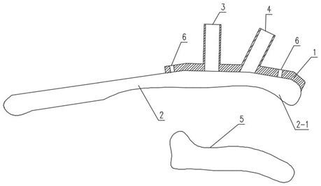 A surgical guide for coracoclavicular ligament reconstruction and its preparation method