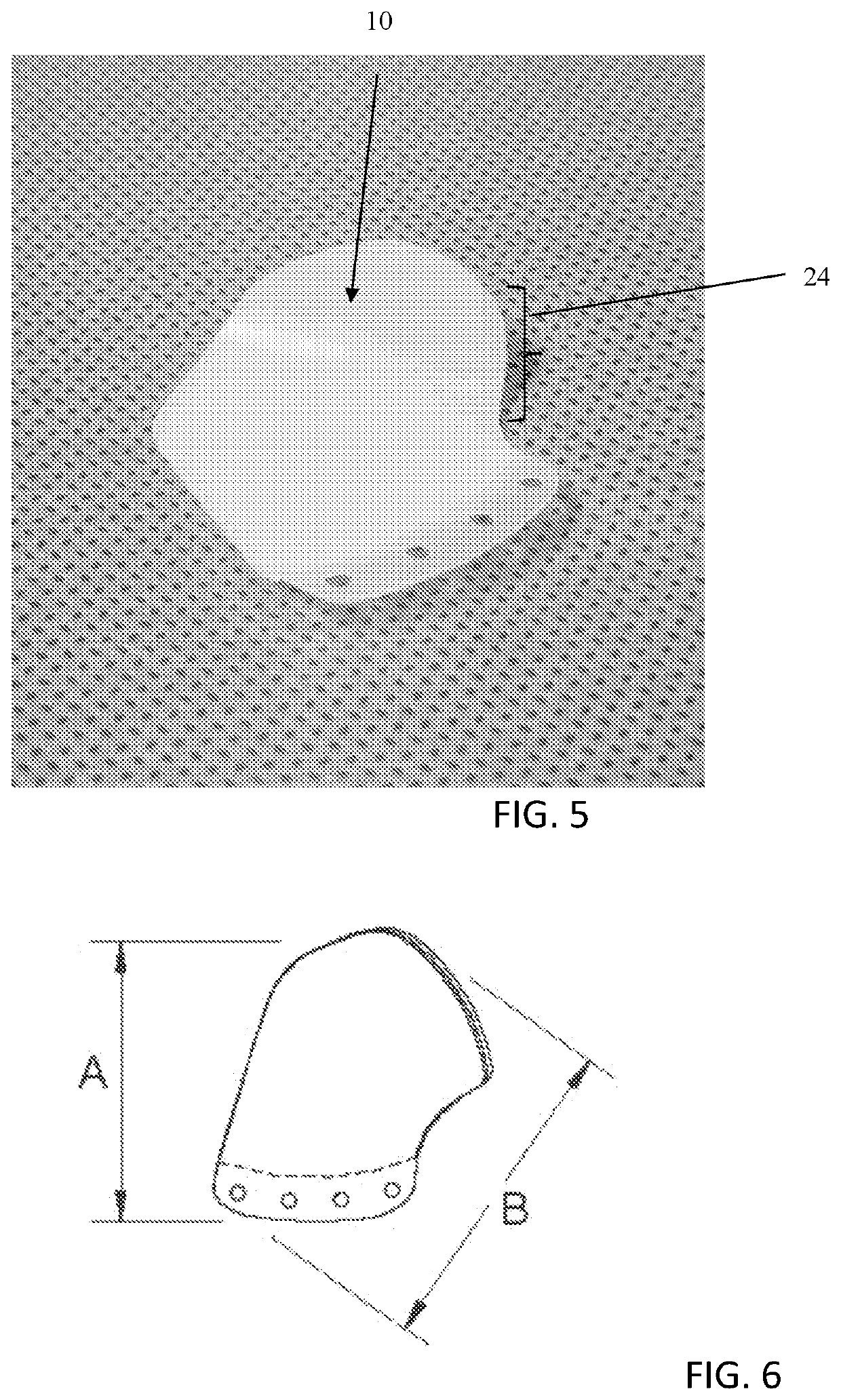 Orbital floor implant