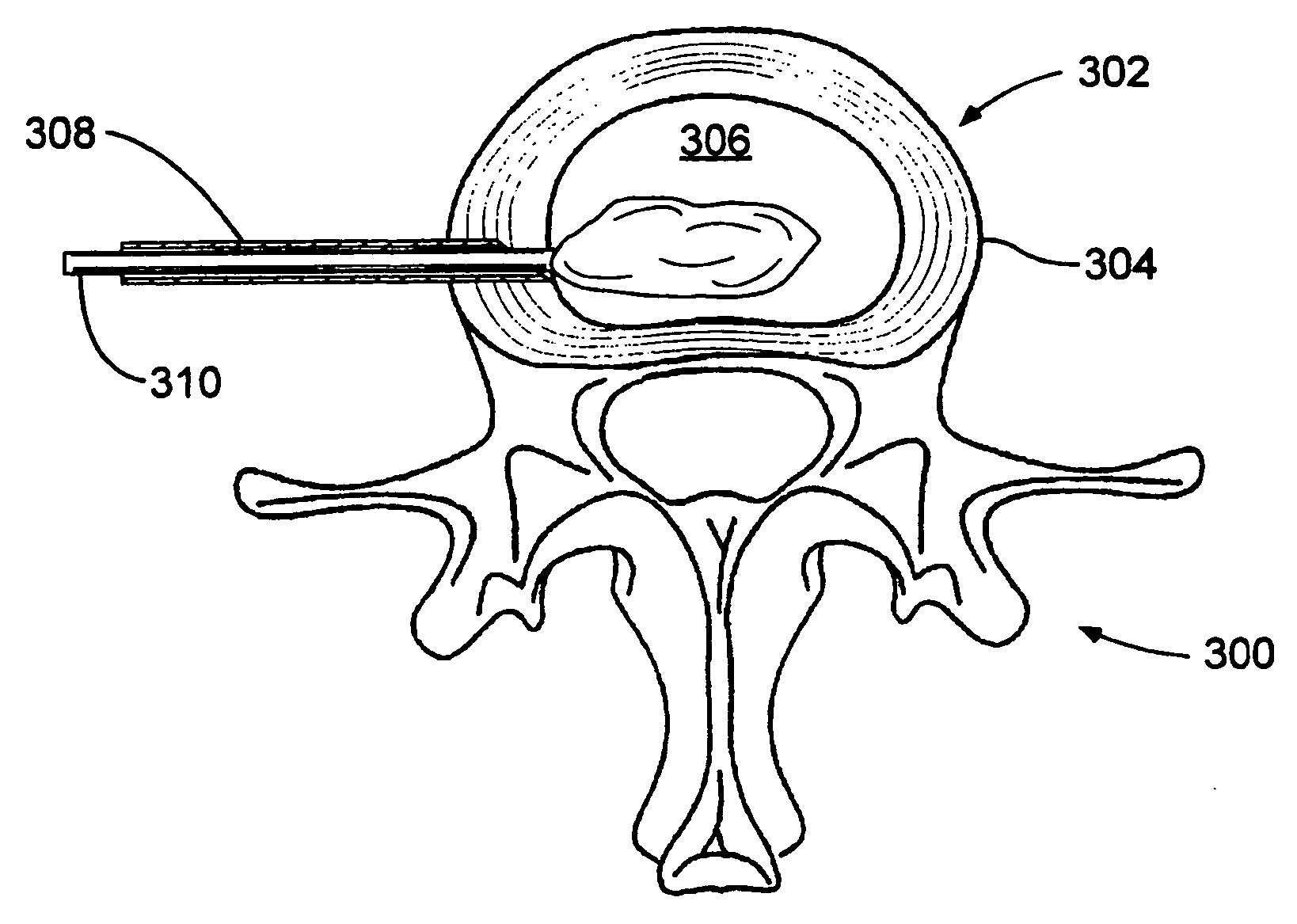 Hydrogel balloon prosthesis for nucleus pulposus