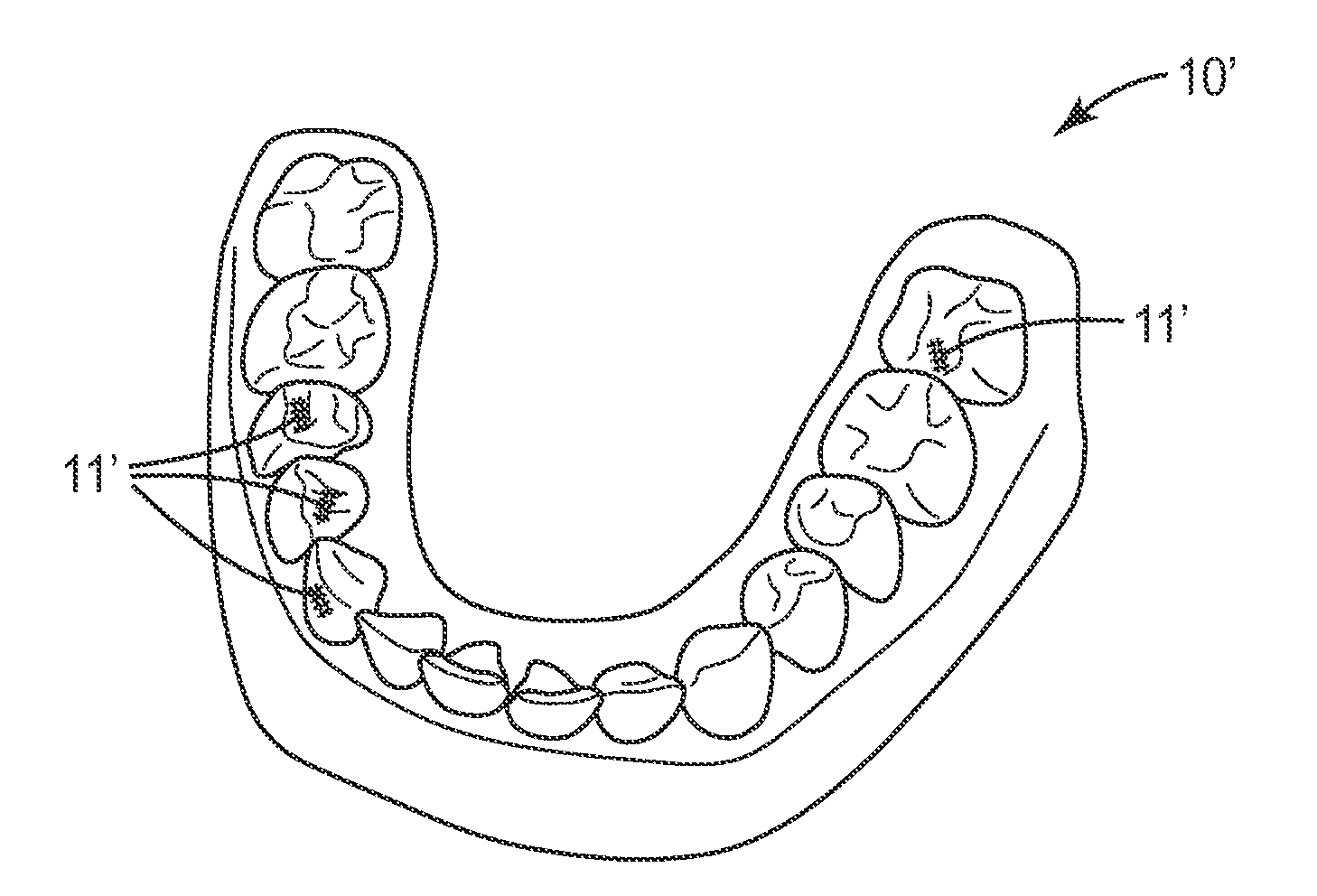 Method in the making of a dental restoration