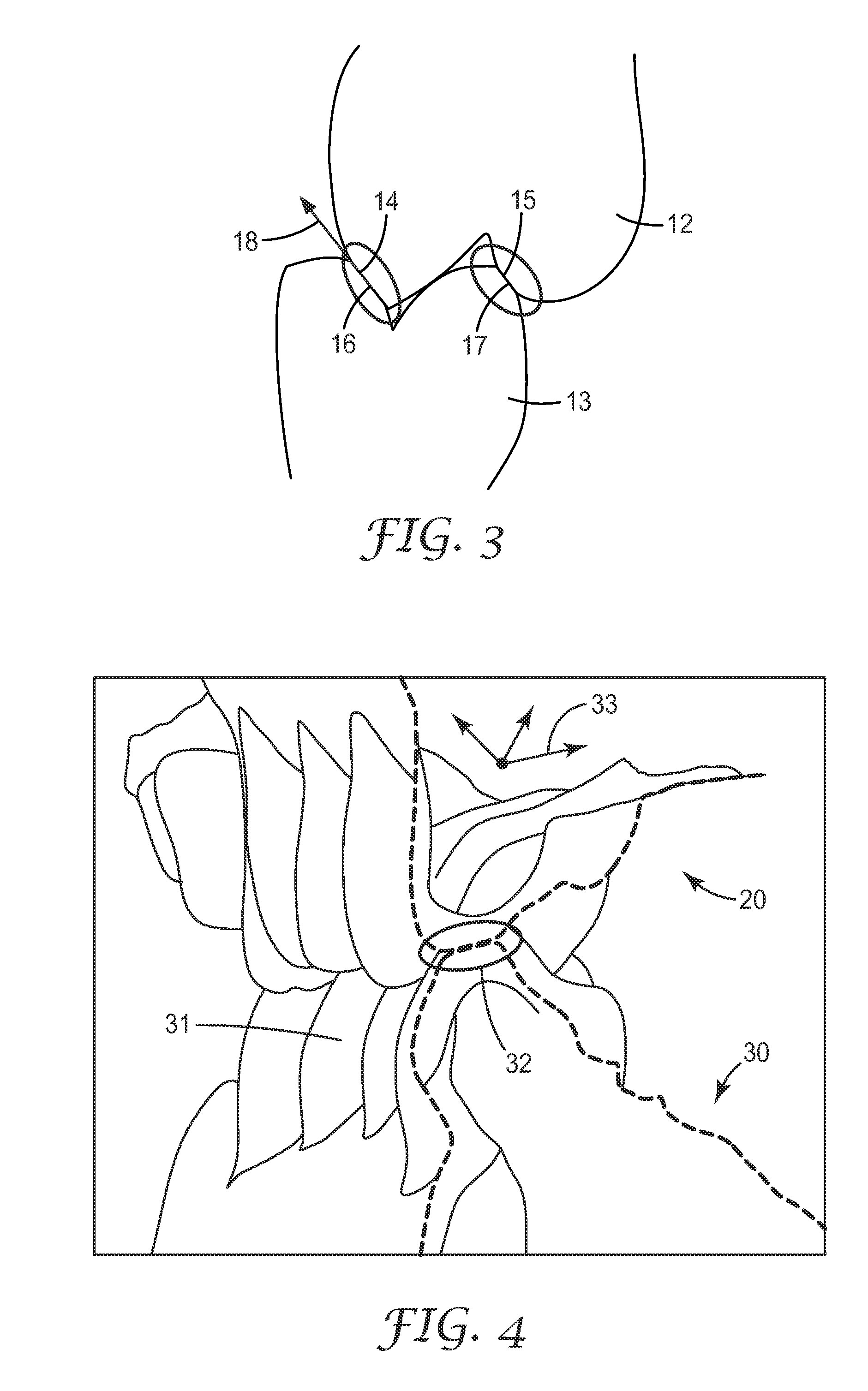 Method in the making of a dental restoration