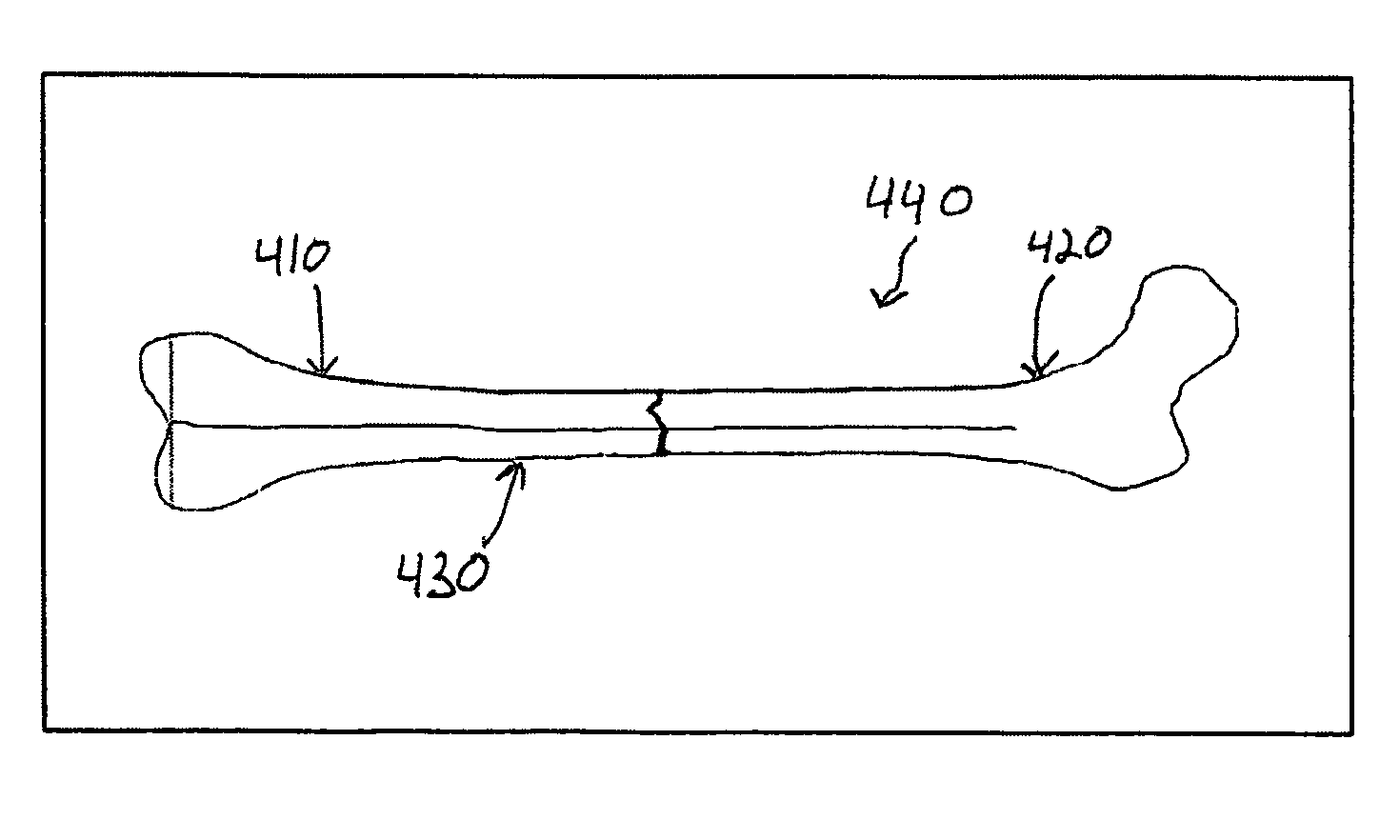 Method and system of computer assistance for the reduction of a fracture