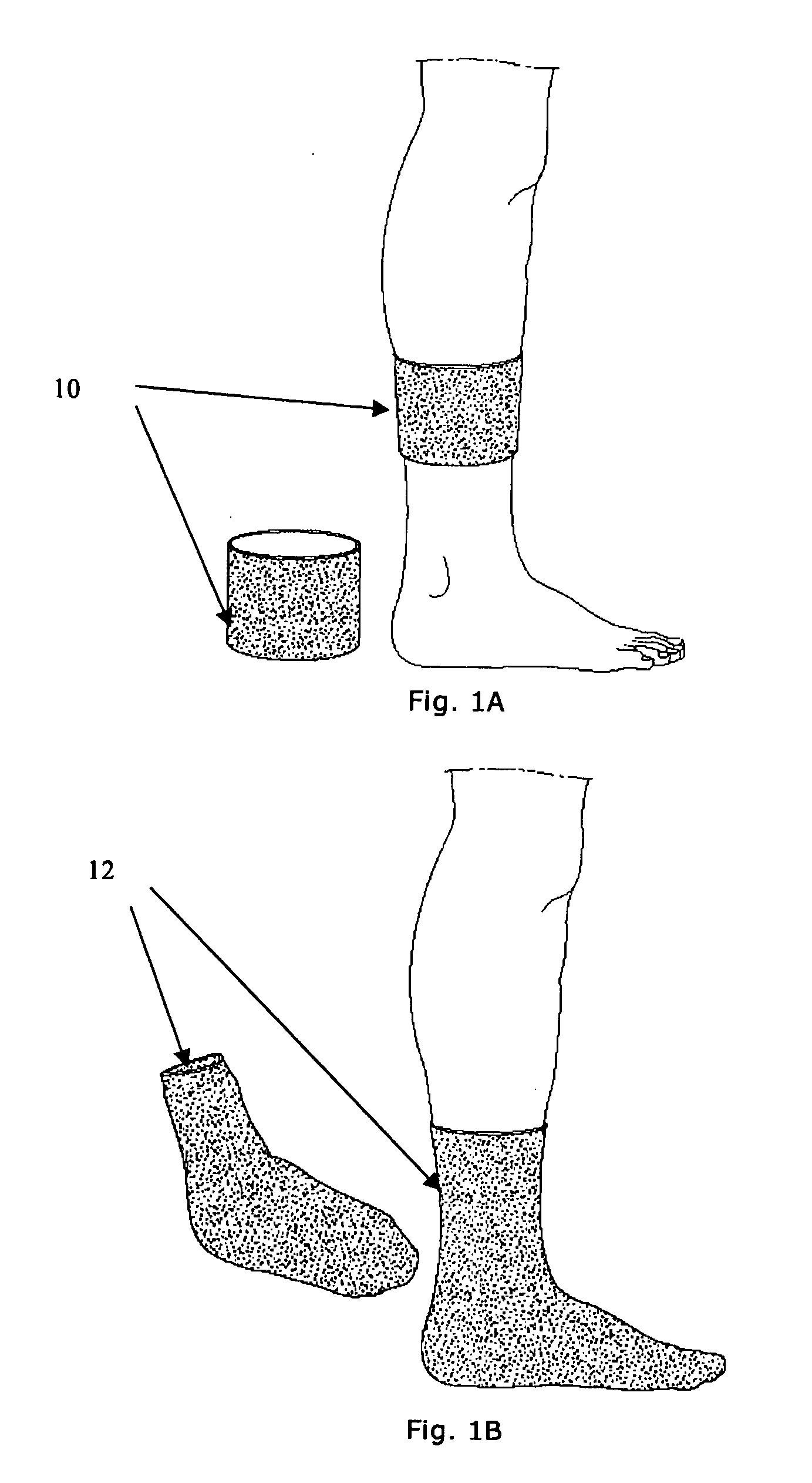 Device, method, and use for treatment of neuropathy involving nitric oxide