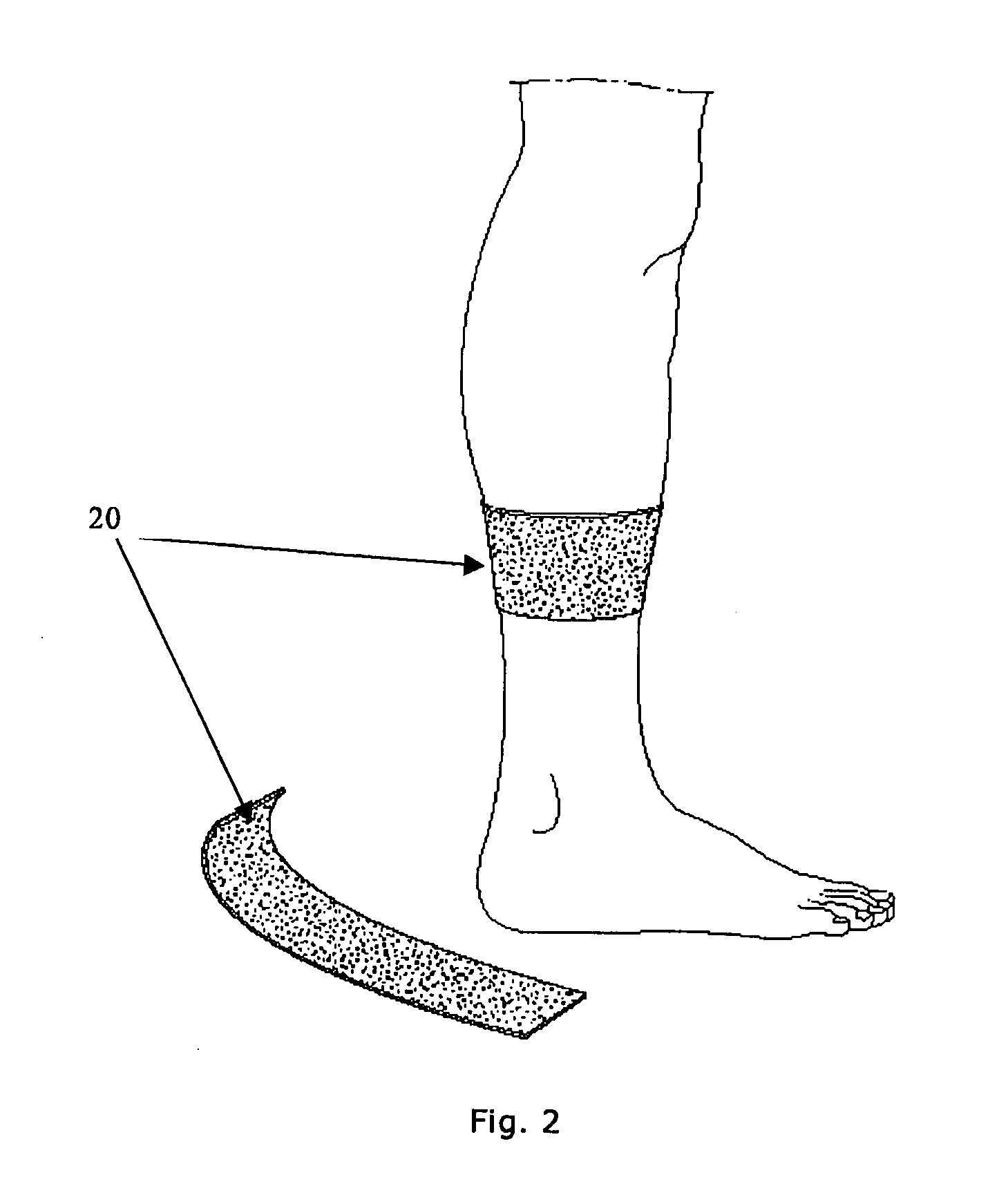 Device, method, and use for treatment of neuropathy involving nitric oxide