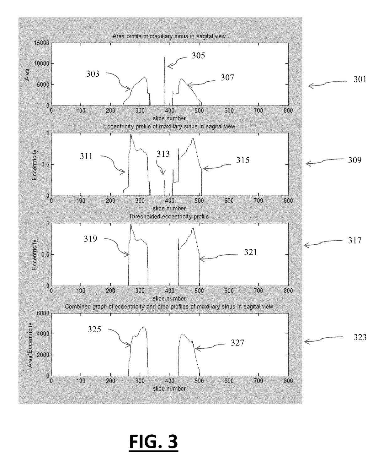 Method And System For Automatic Volumetric-Segmentation Of Human Upper Respiratory Tract