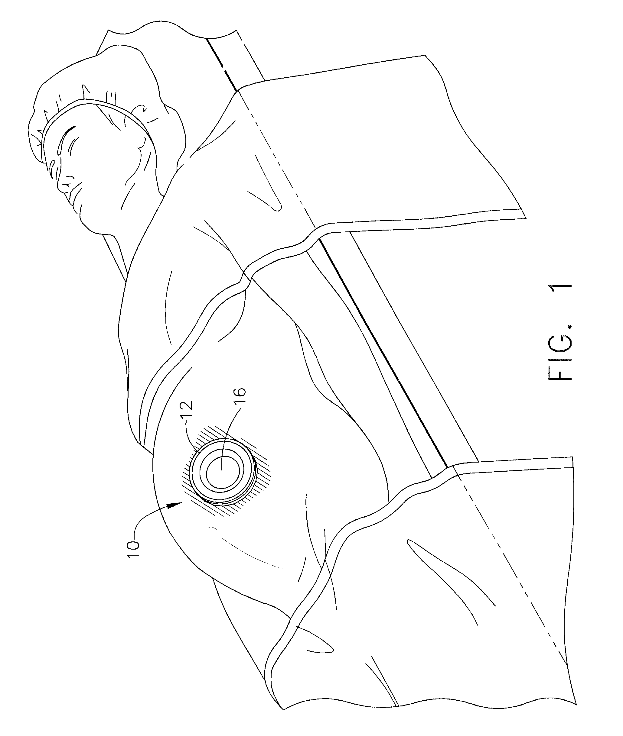 Resiliently Supported Seal Cap for Hand Assisted Laparoscopic Surgical Procedures