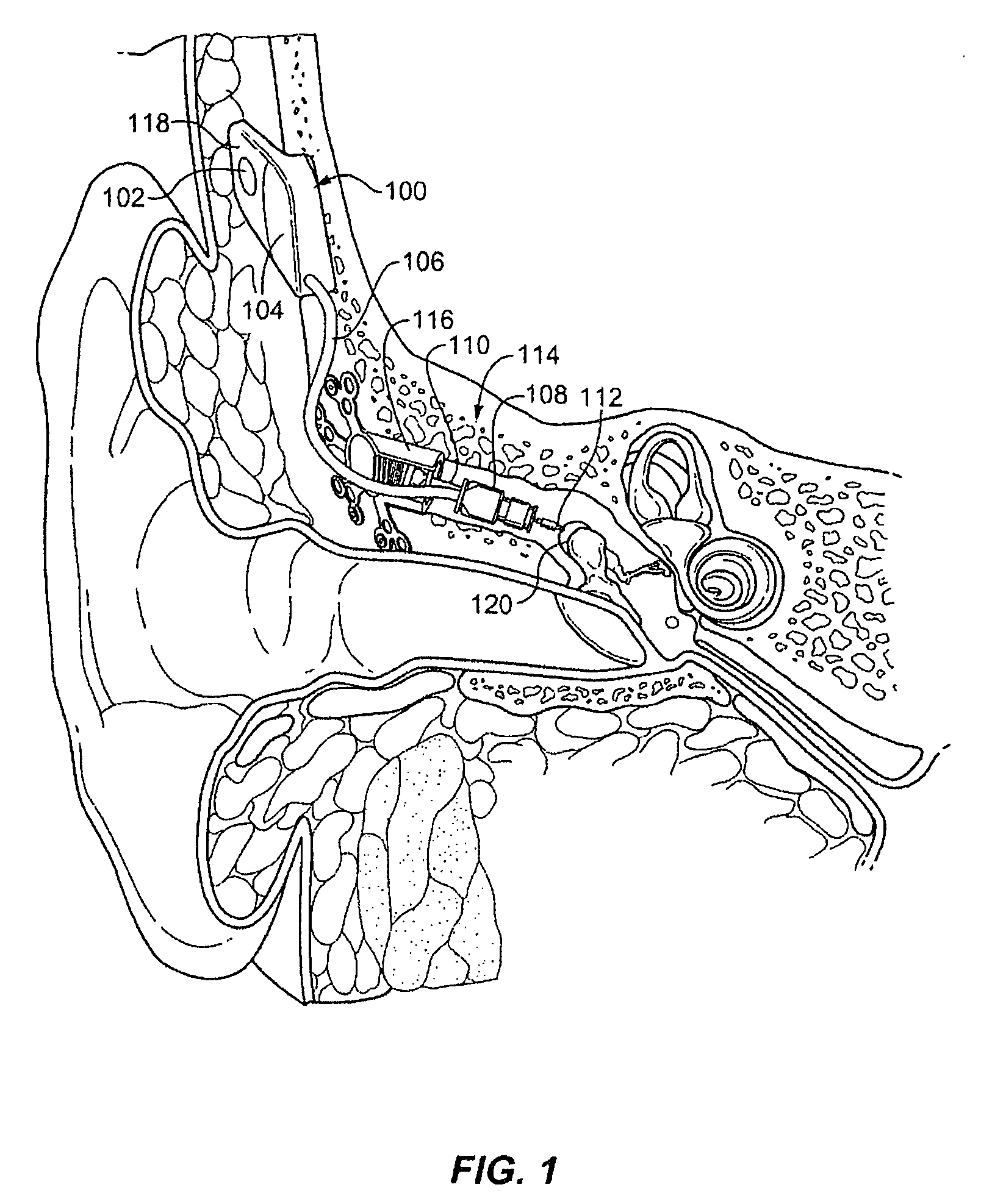 Phase based feedback oscillation prevention in hearing aids