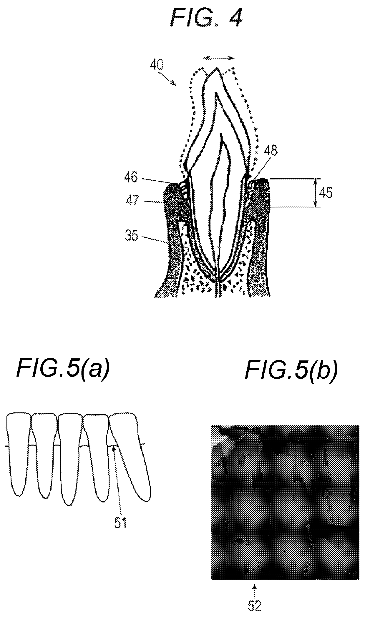 Method for periodontal disease measurement