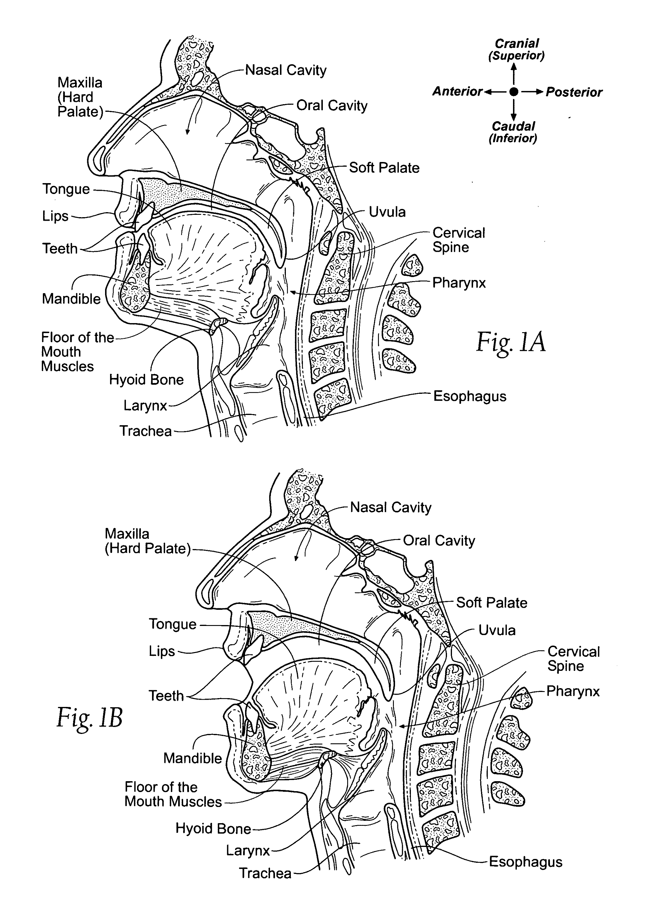 Apparatus, systems, and methods for constraining and/or supporting tissue structures along an airway