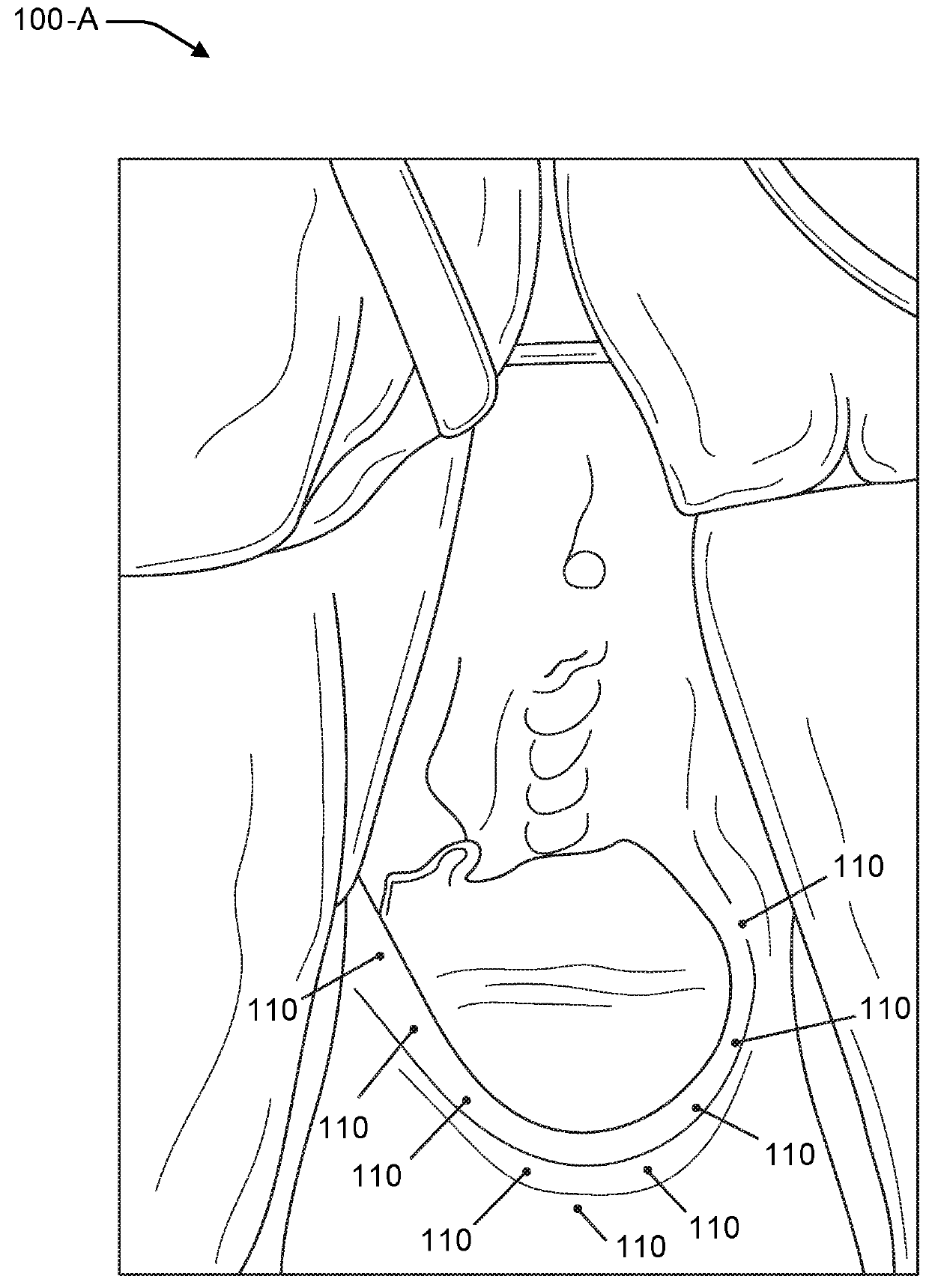 Vaginal rejuvenation methods and devices