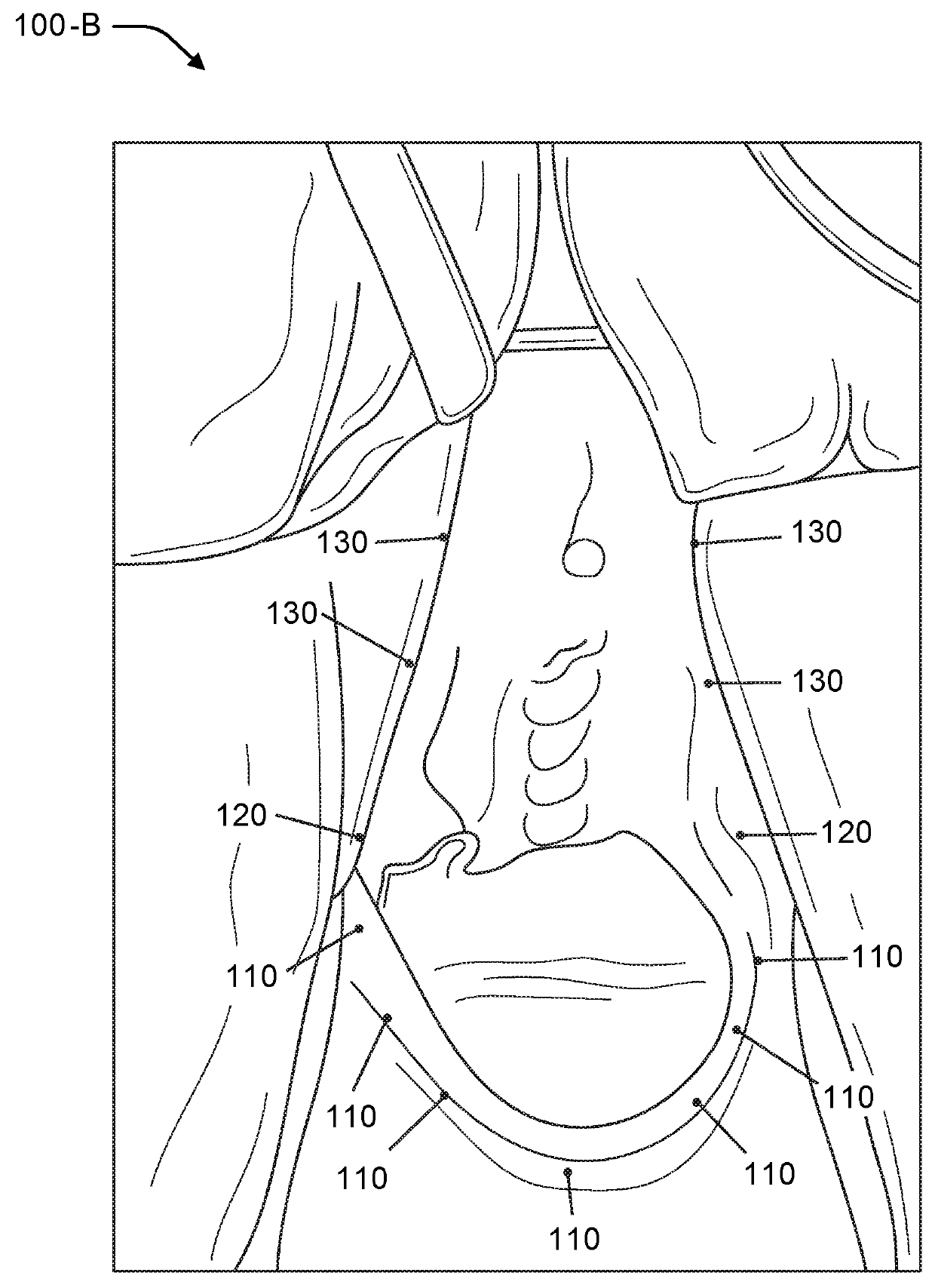 Vaginal rejuvenation methods and devices