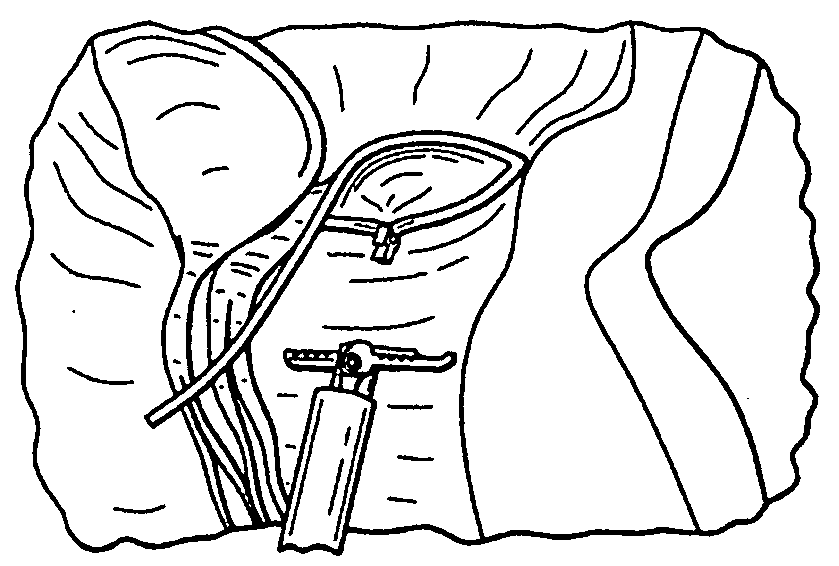 Method and system for plicating tissue in a minimally invasive medical procedure for the treatment of mitral valve regurgitation