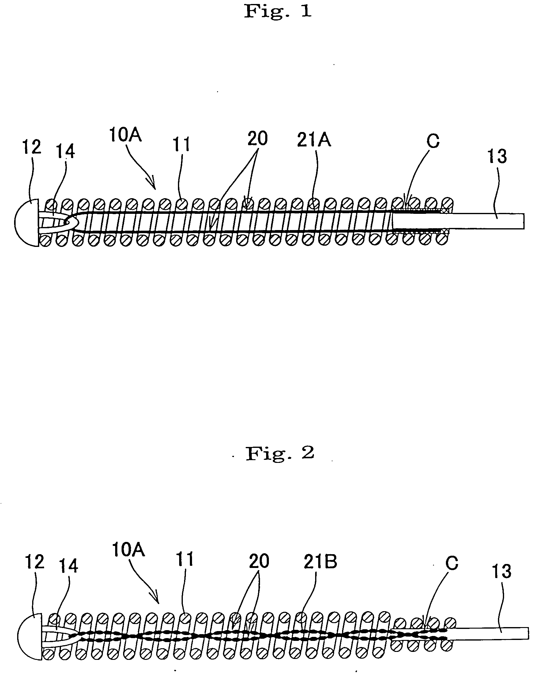 Indwelling implant for embolization