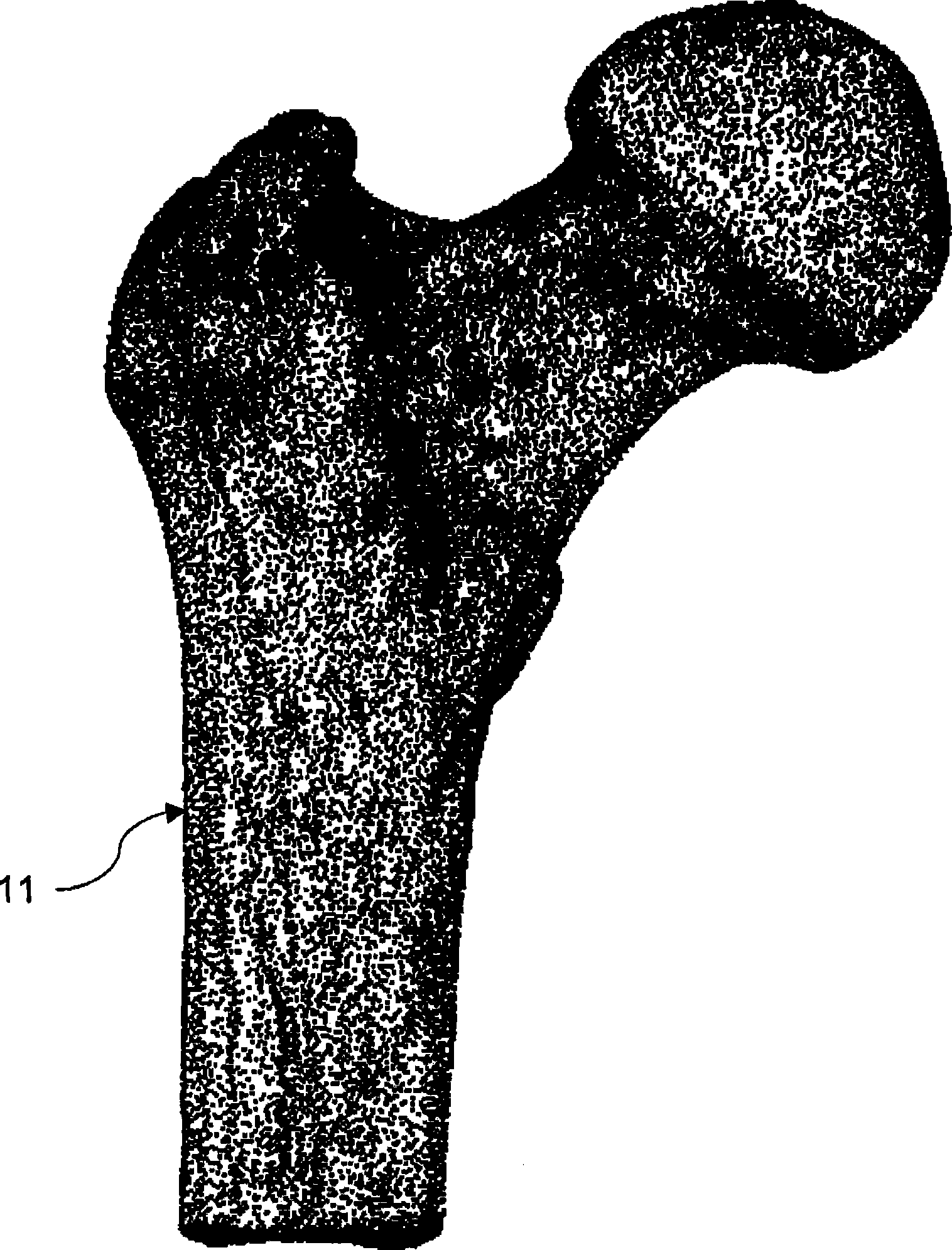 Digital data design method of local joint surface implant