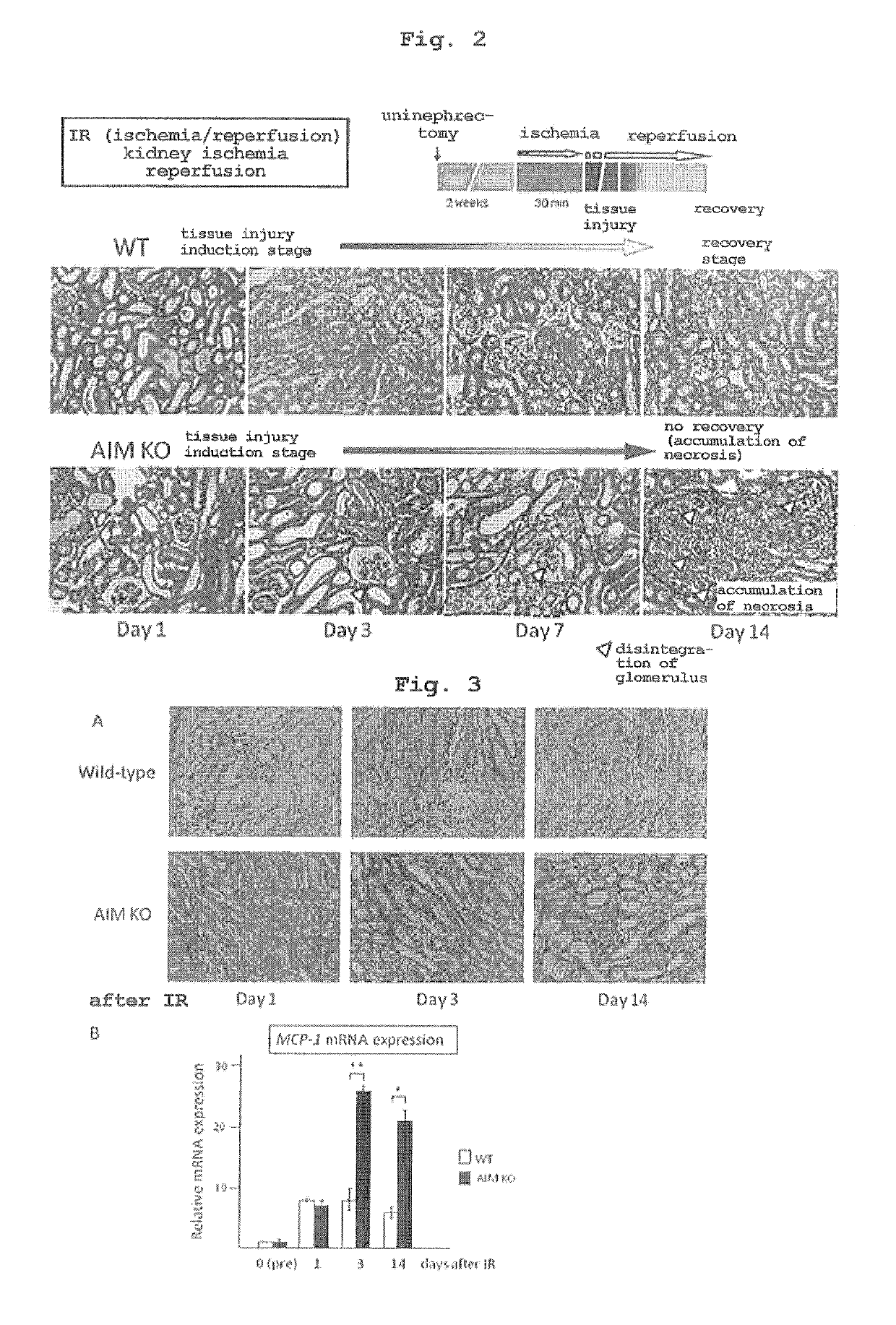 Preventive or therapeutic agent for kidney disease