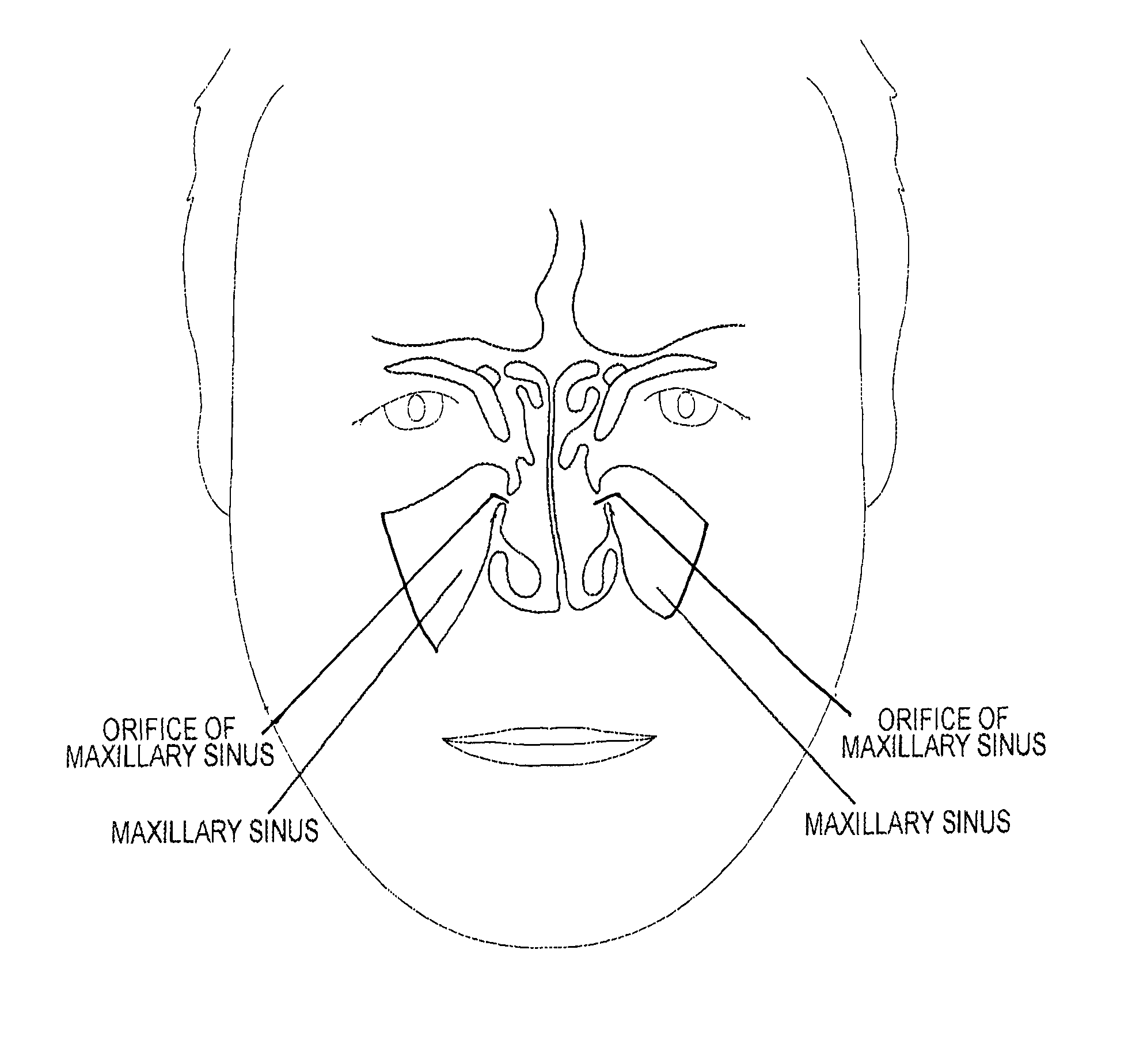 Device and method for delivering therapeutic substances to the maxillary sinus of a patient