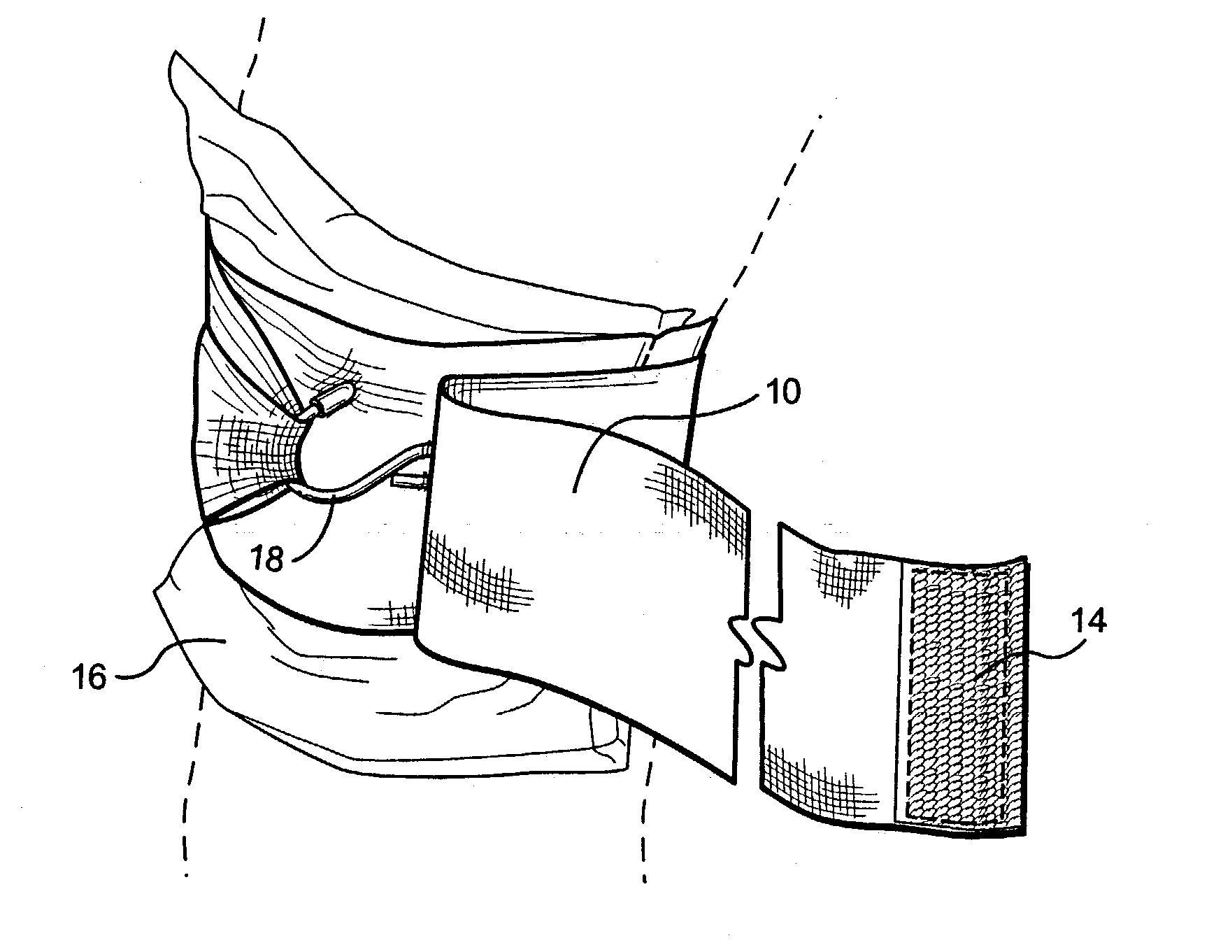 Compression bandage with tightening means