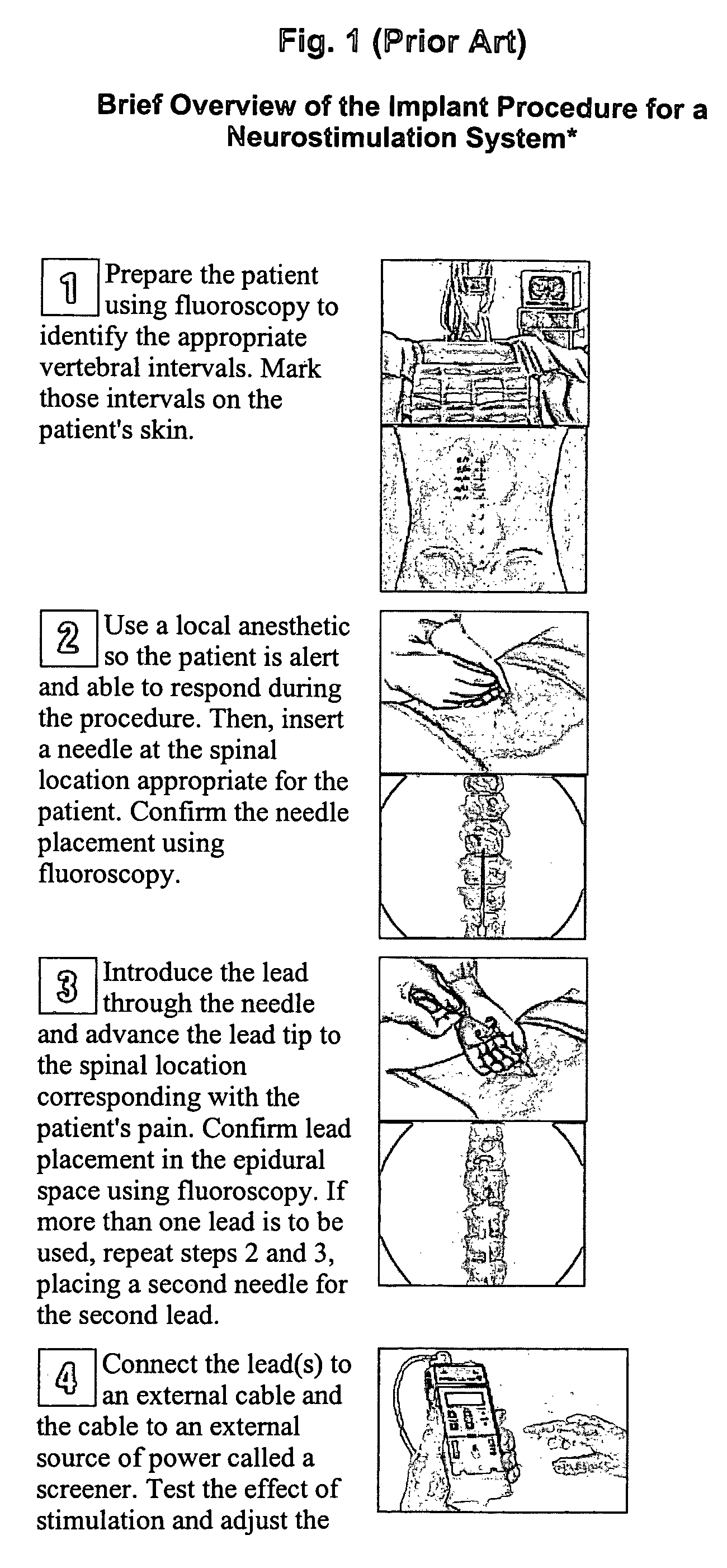 Tunneling needle design having an on-demand removable hub