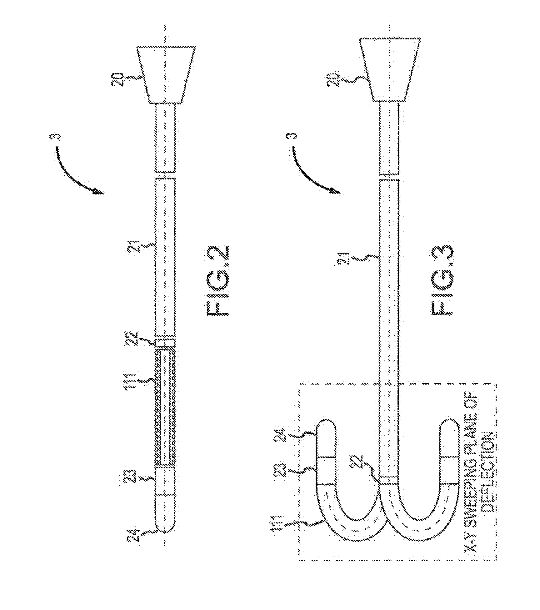 Deflectable Catheter Bodies with Corrugated Tubular Structures