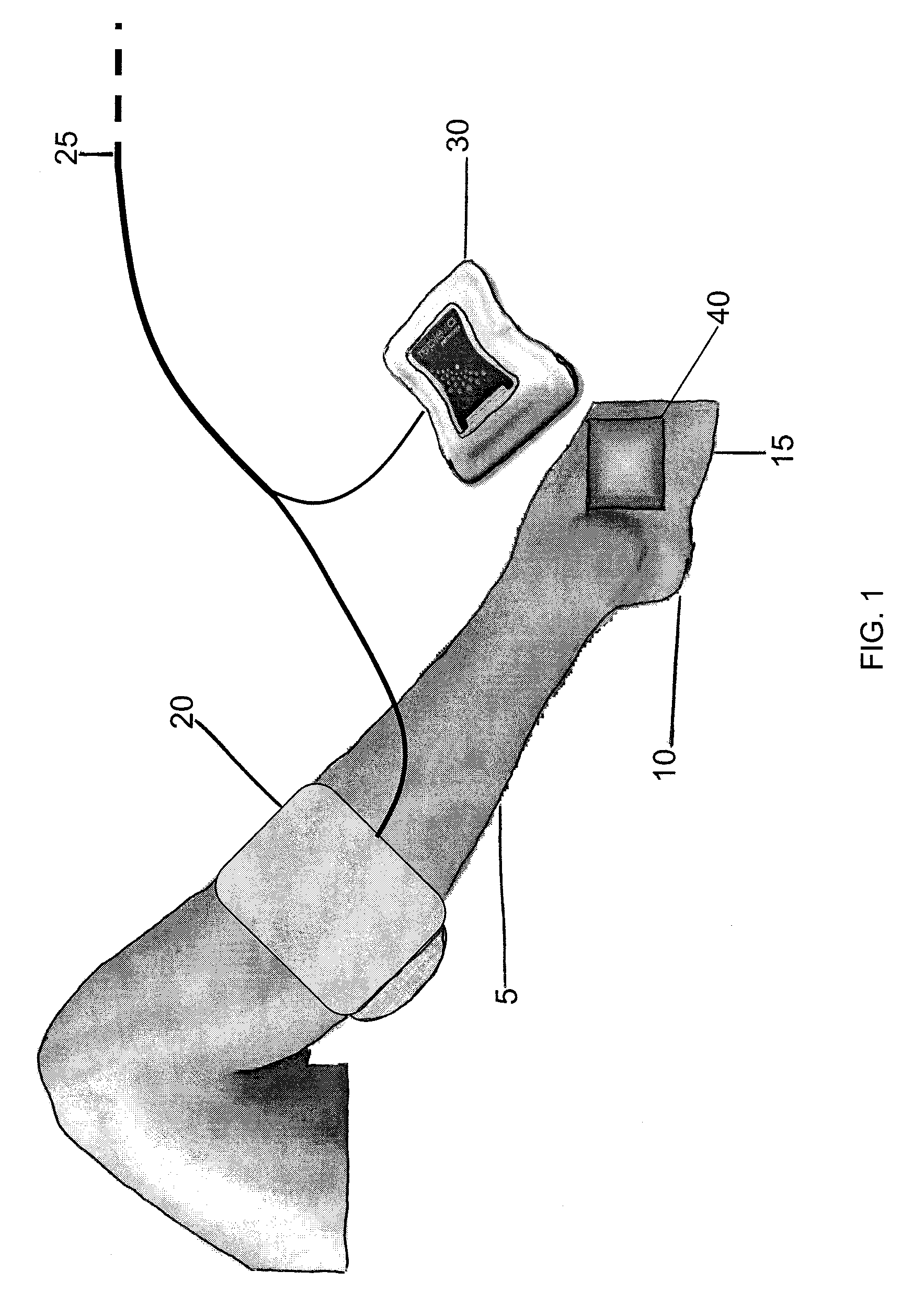 Method of treating a severe diabetic ulcer