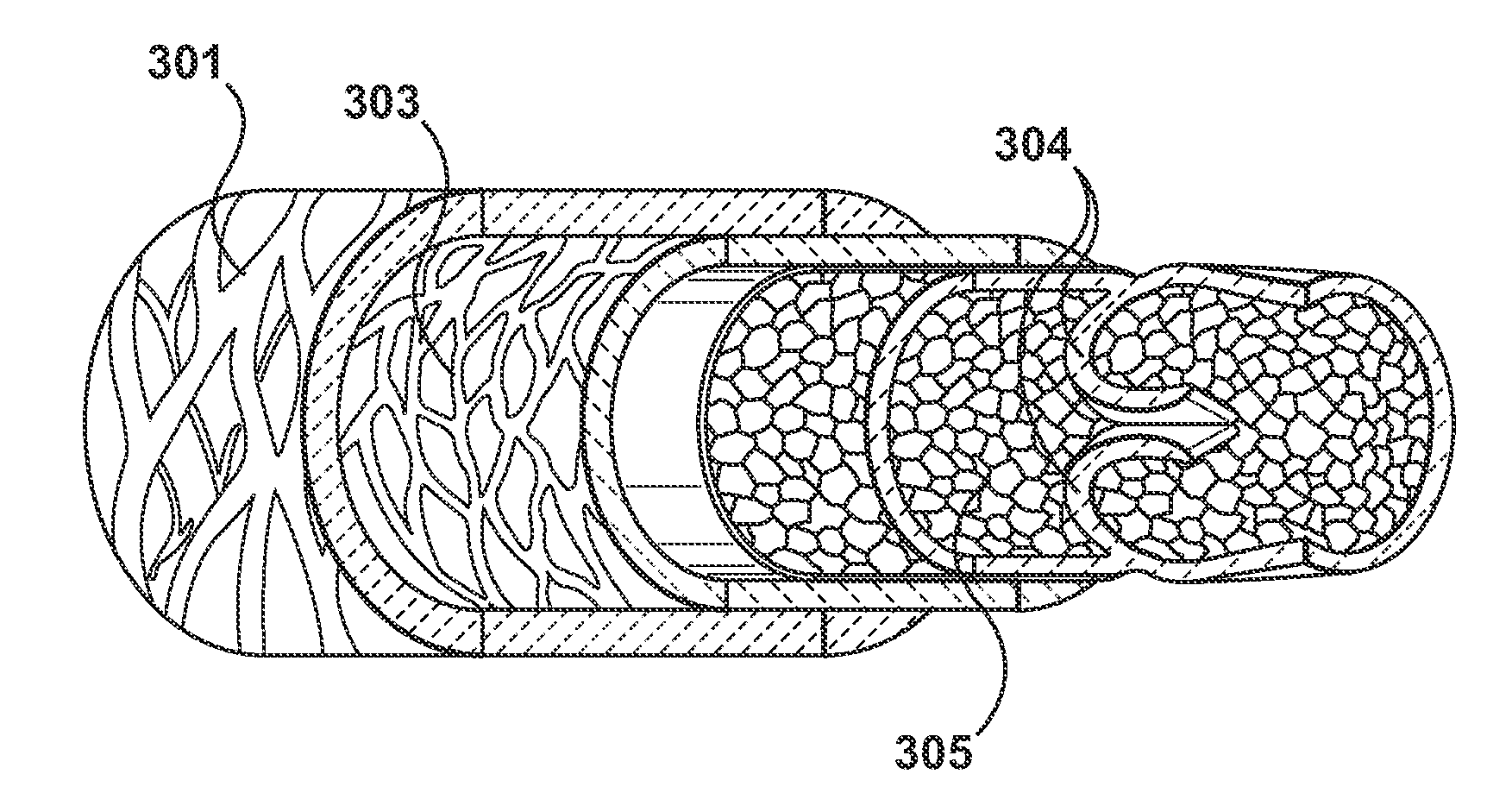 Percutaneous Methods for Apparatus for Creating Native Tissue Venous Valves