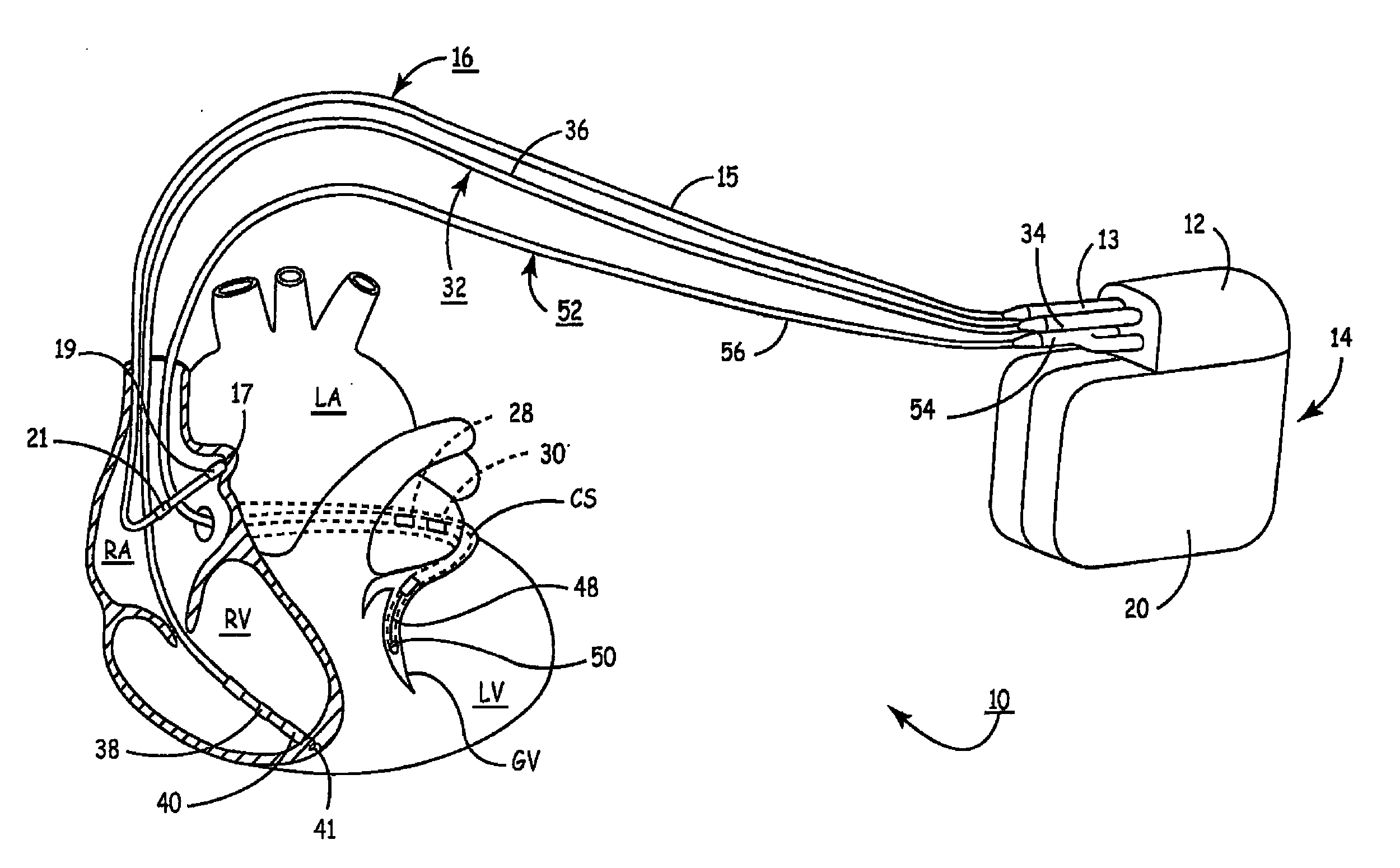 Method of continuous capture verification in cardiac resynchronization devices