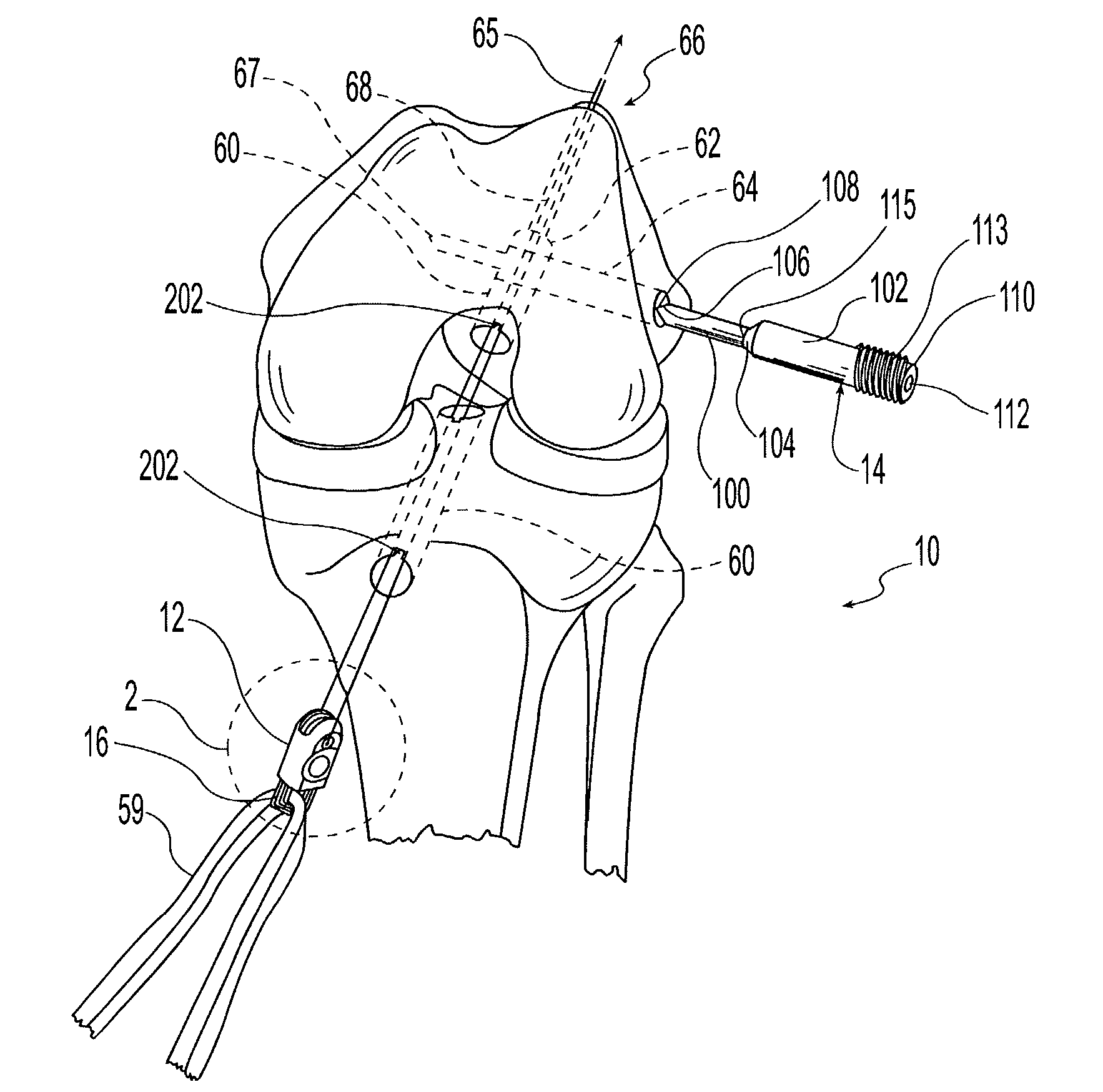 Two piece cross-pin graft fixation