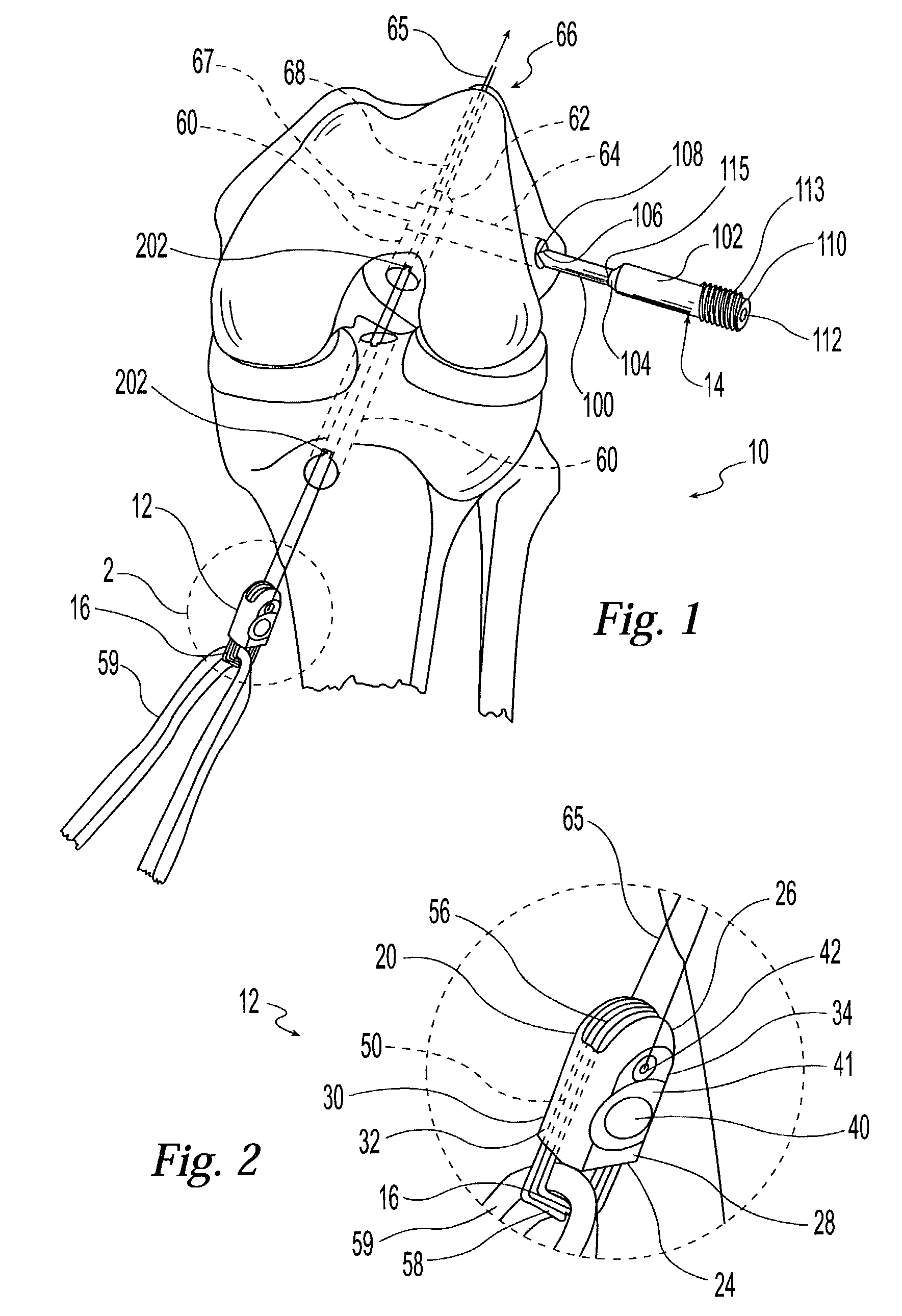 Two piece cross-pin graft fixation