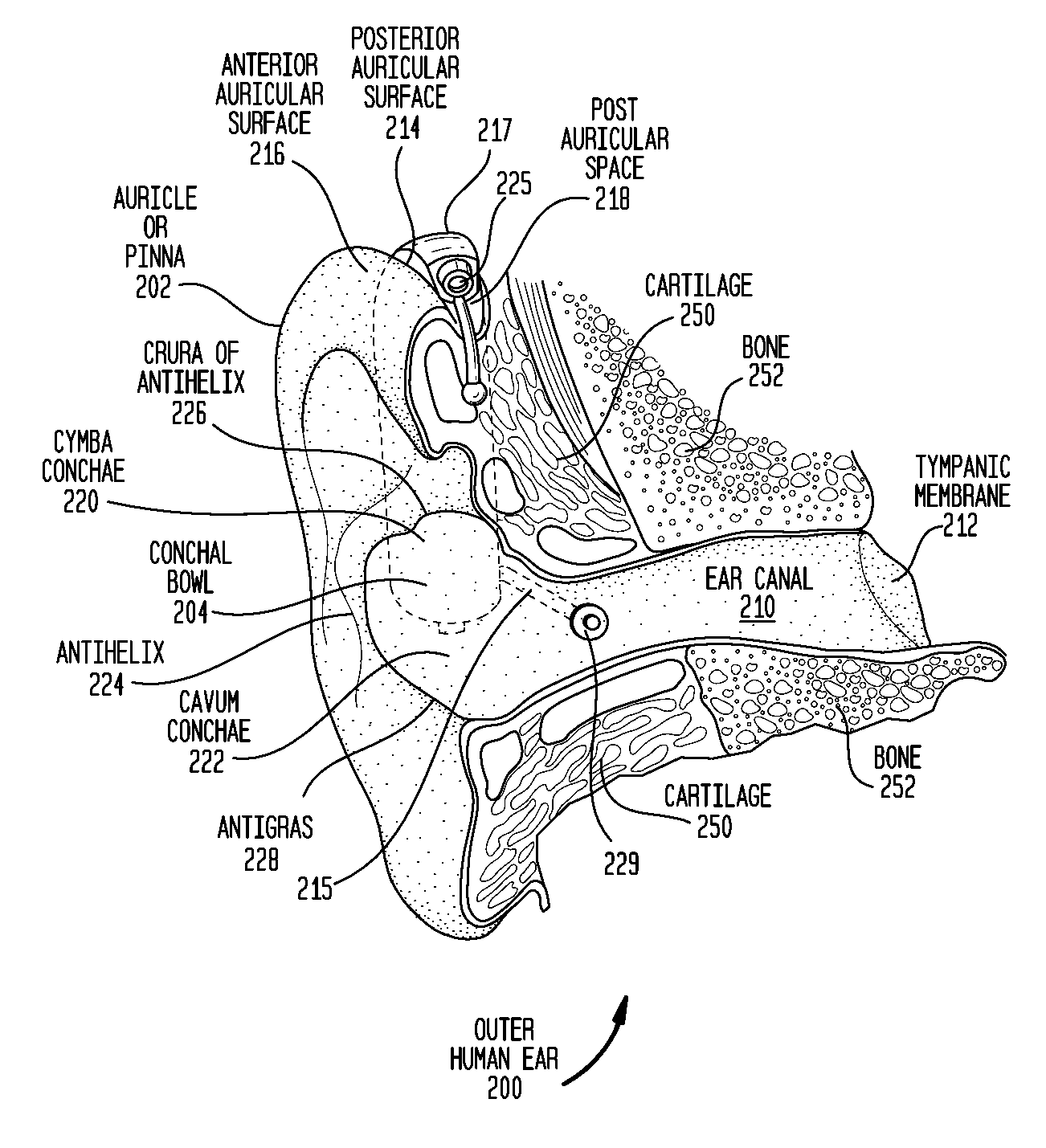 Piercing conducted bone conduction device