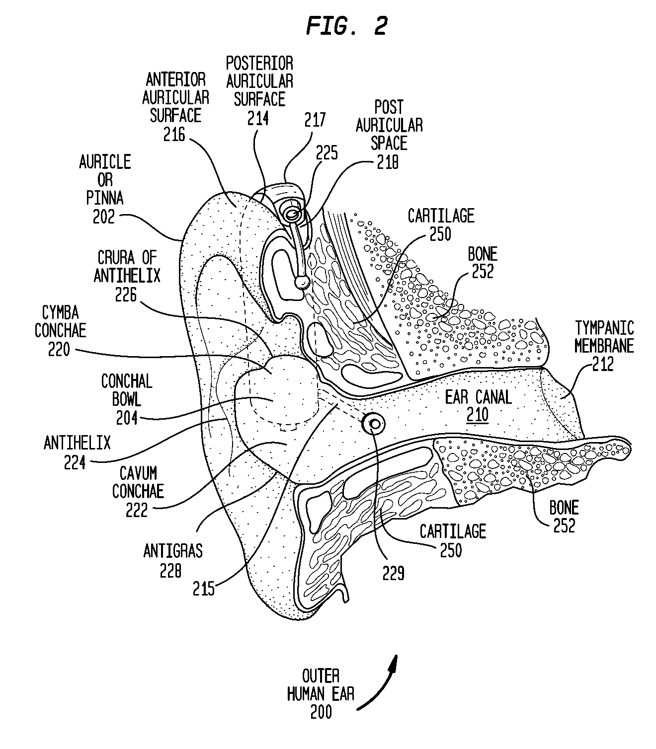 Piercing conducted bone conduction device