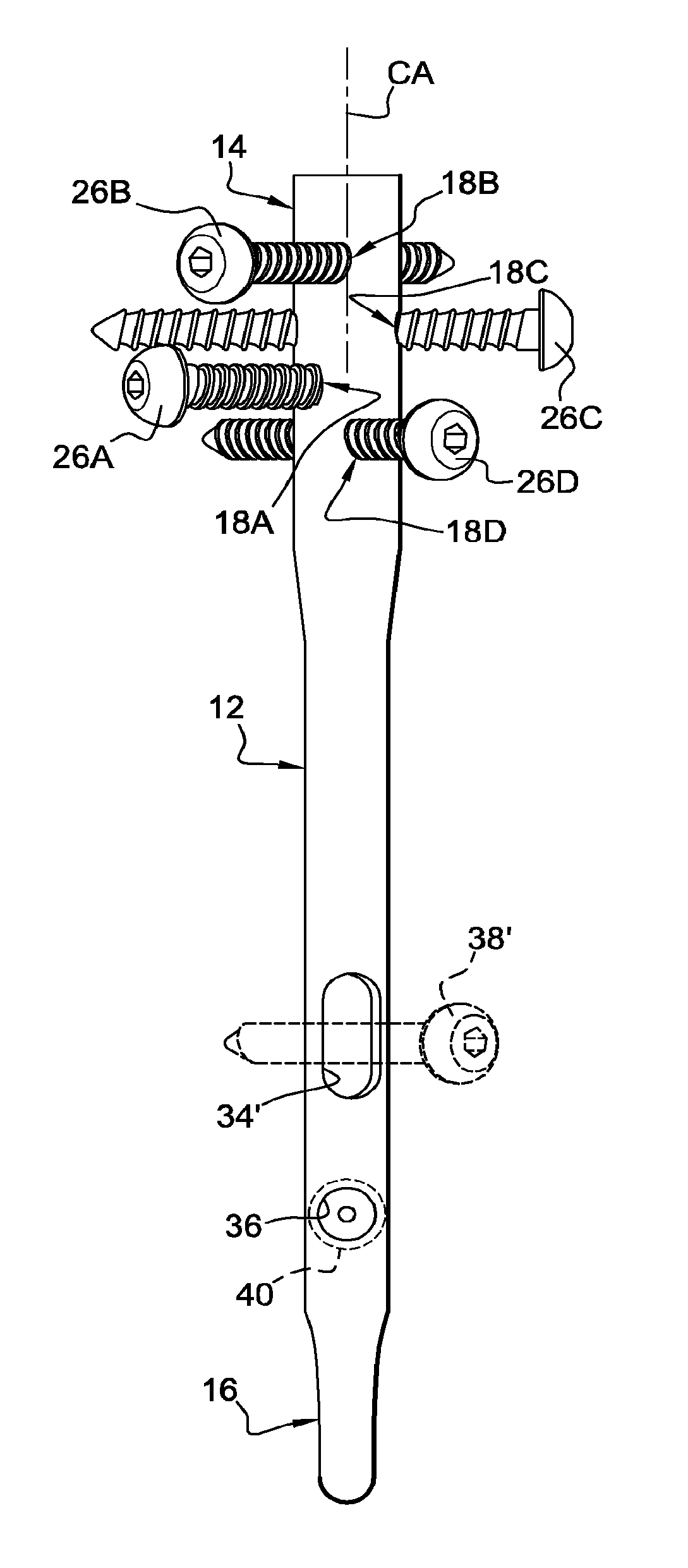 Surgical technique and apparatus for proximal humeral fracture repair