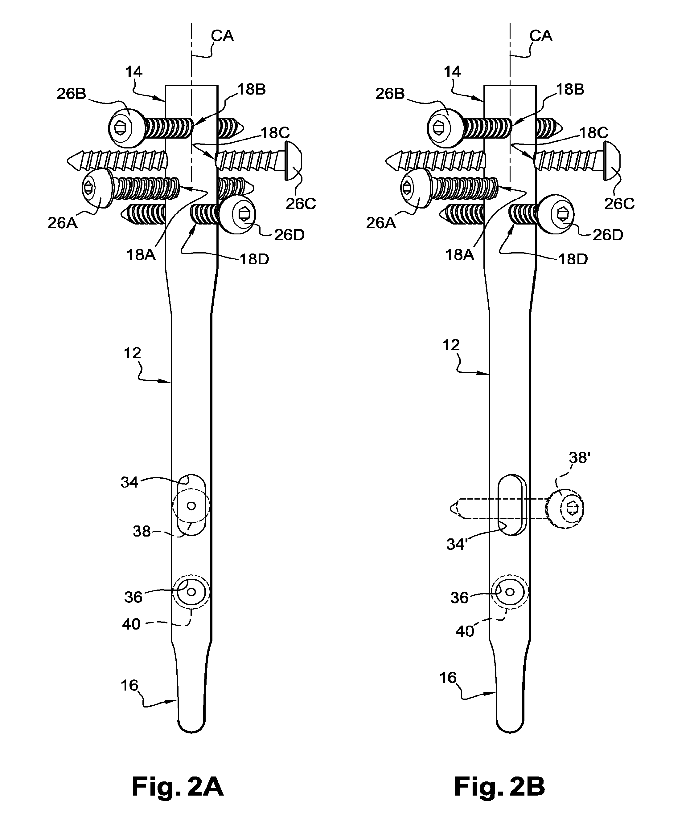 Surgical technique and apparatus for proximal humeral fracture repair